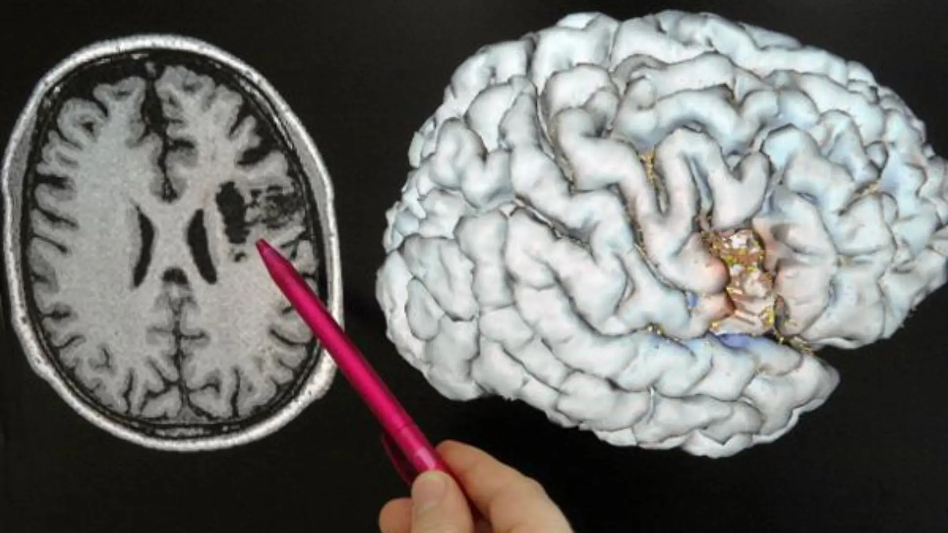 An einer Schichtaufnahmen eines Gehirns, die mit einem Magnetresonanztomographen aufgenommen worden ist, zeigt der Direktor der Klinik für Neurologie der Jenaer Friedrich-Schiller-Universität, Prof. Dr. Otto W. Witte, auf einen Bereich, der durch einen Schlaganfall geschädigt ist (Archivfoto vom 04.08.2004). Philosophen plagen Zukunftsängste: Macht die moderne Hirnforschung die Ethik überflüssig? Über diese Frage wollen Philosophen bei einem Symposium am kommenden Donnerstag (20.01.2005) und Freitag in Frankfurt diskutieren. Foto: Jan-Peter Kasper dpa/lhe (zu dpa-Korr "Gehirn, Freiheit, Ethik: Philosophen diskutieren mit Hirnforschern" vom 15.01.2005) +++(c) dpa - Bildfunk+++