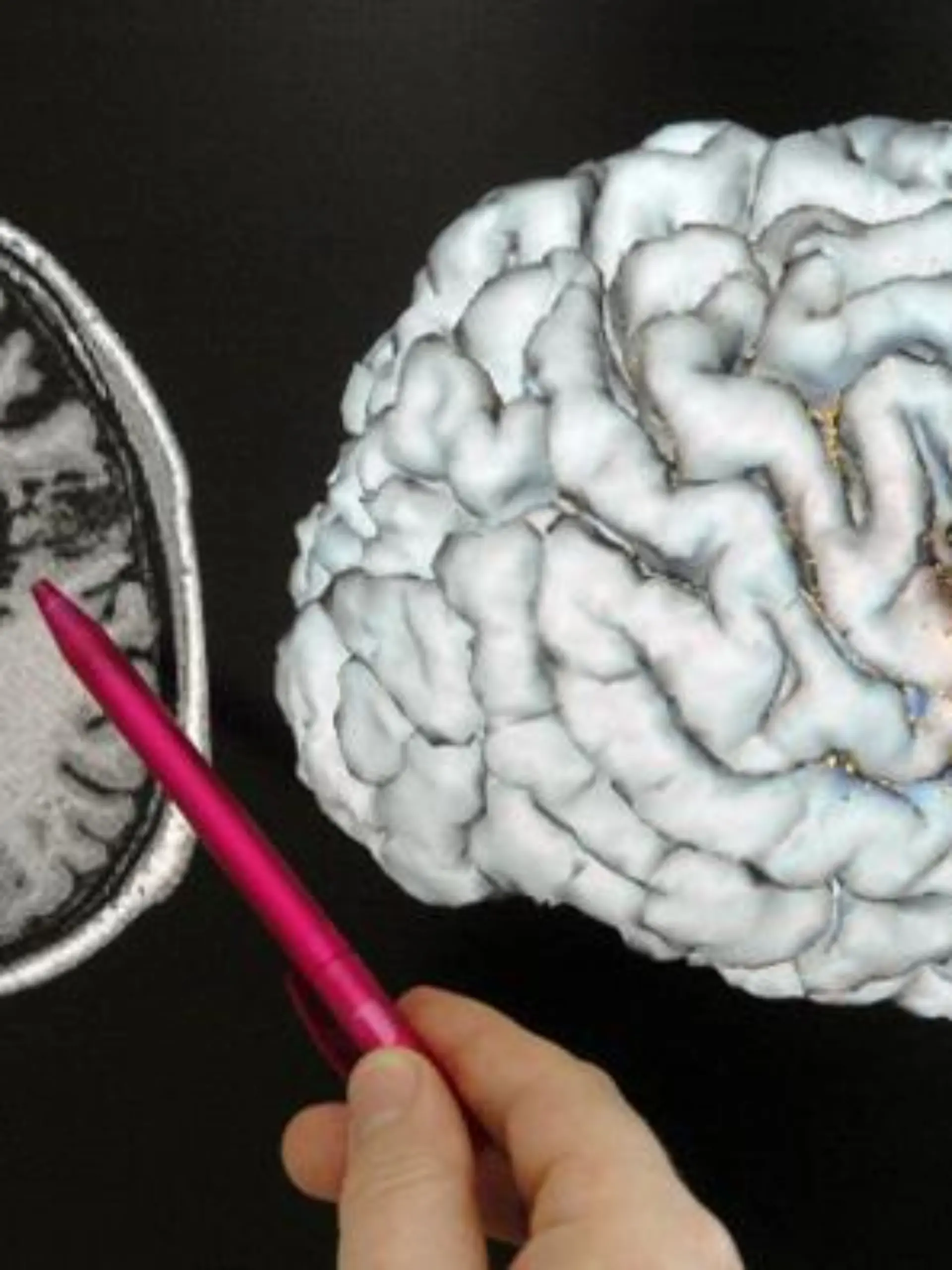 An einer Schichtaufnahmen eines Gehirns, die mit einem Magnetresonanztomographen aufgenommen worden ist, zeigt der Direktor der Klinik für Neurologie der Jenaer Friedrich-Schiller-Universität, Prof. Dr. Otto W. Witte, auf einen Bereich, der durch einen Schlaganfall geschädigt ist (Archivfoto vom 04.08.2004). Philosophen plagen Zukunftsängste: Macht die moderne Hirnforschung die Ethik überflüssig? Über diese Frage wollen Philosophen bei einem Symposium am kommenden Donnerstag (20.01.2005) und Freitag in Frankfurt diskutieren. Foto: Jan-Peter Kasper dpa/lhe (zu dpa-Korr "Gehirn, Freiheit, Ethik: Philosophen diskutieren mit Hirnforschern" vom 15.01.2005)  +++(c) dpa - Bildfunk+++