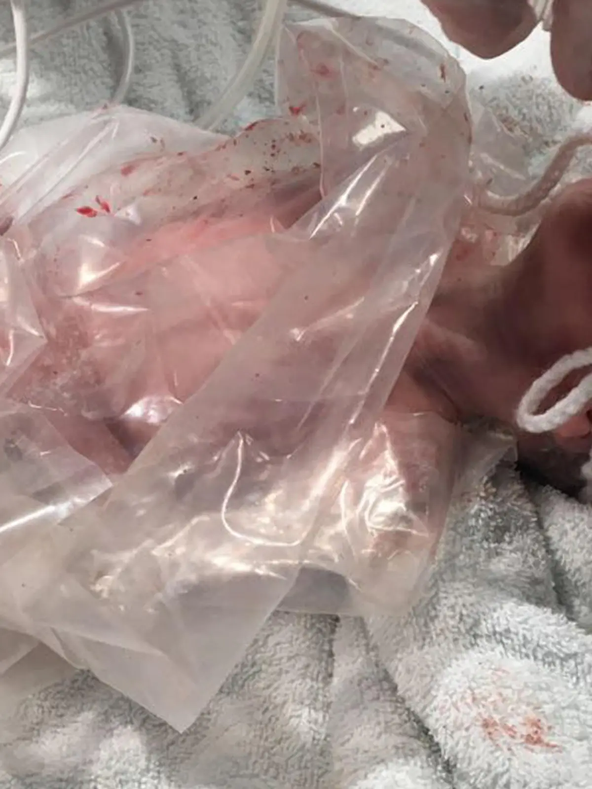 Baby liegt mit einer Plastiktüte umwickelt im Krankenhaus