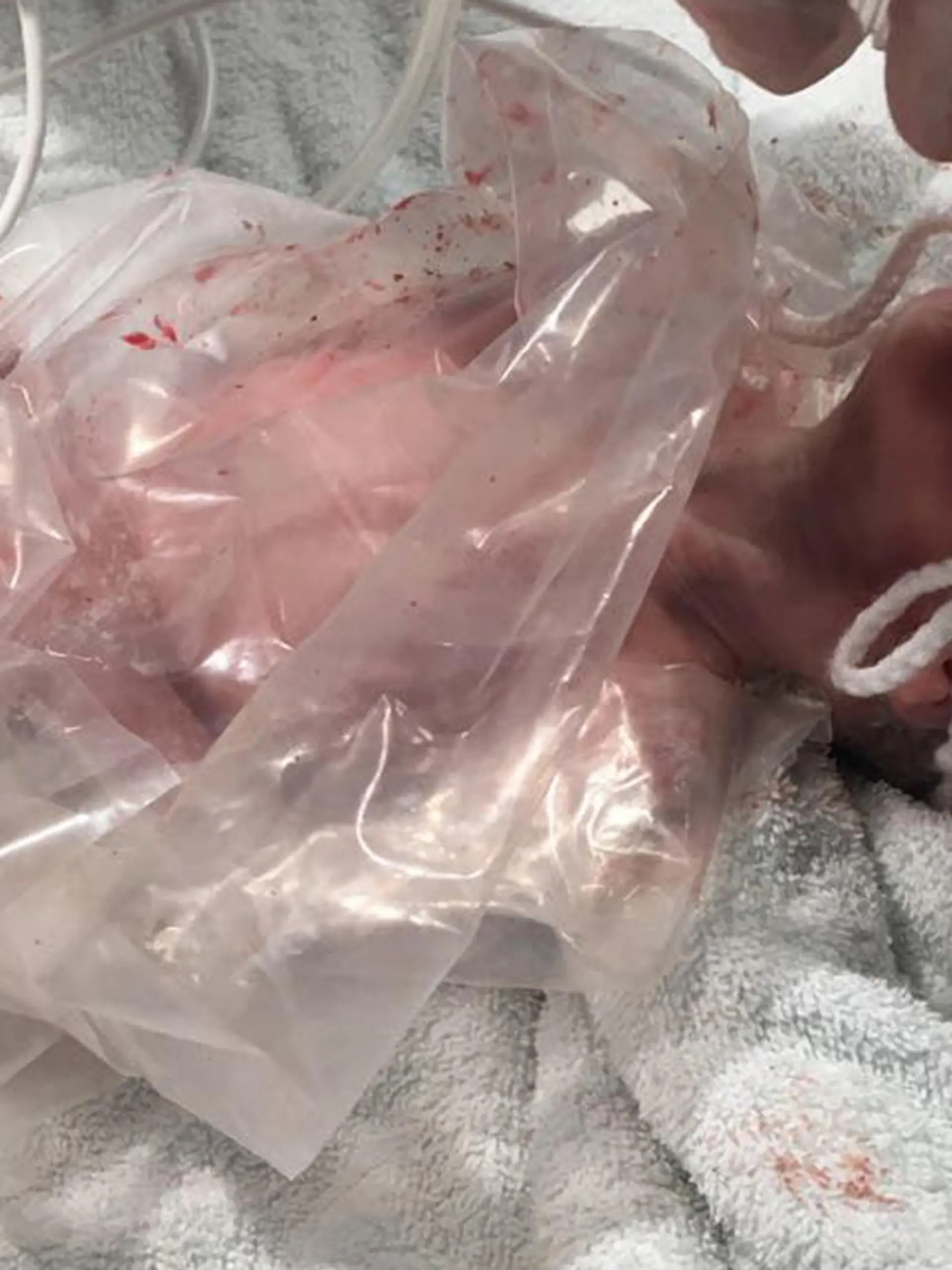 Baby liegt mit einer Plastiktüte umwickelt im Krankenhaus