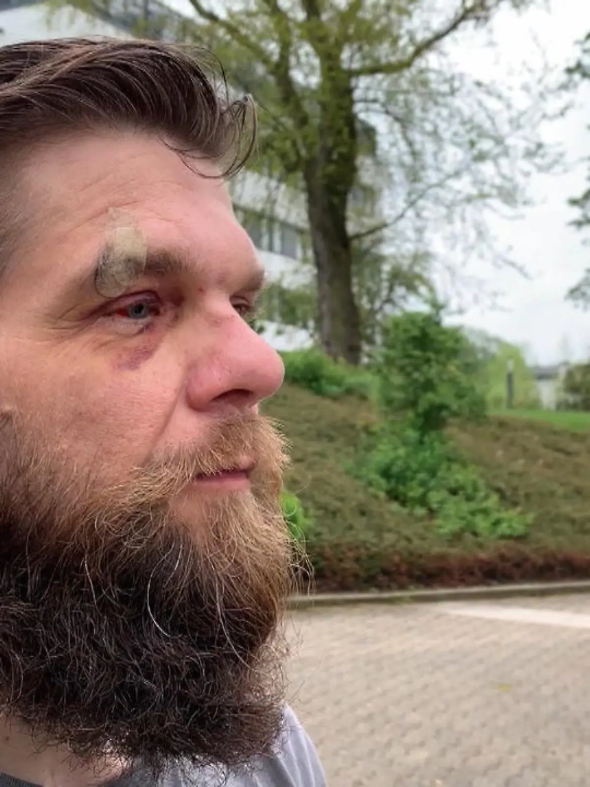 Bild zu: "Discgolf-Scheibe trifft Mann im Gesich"