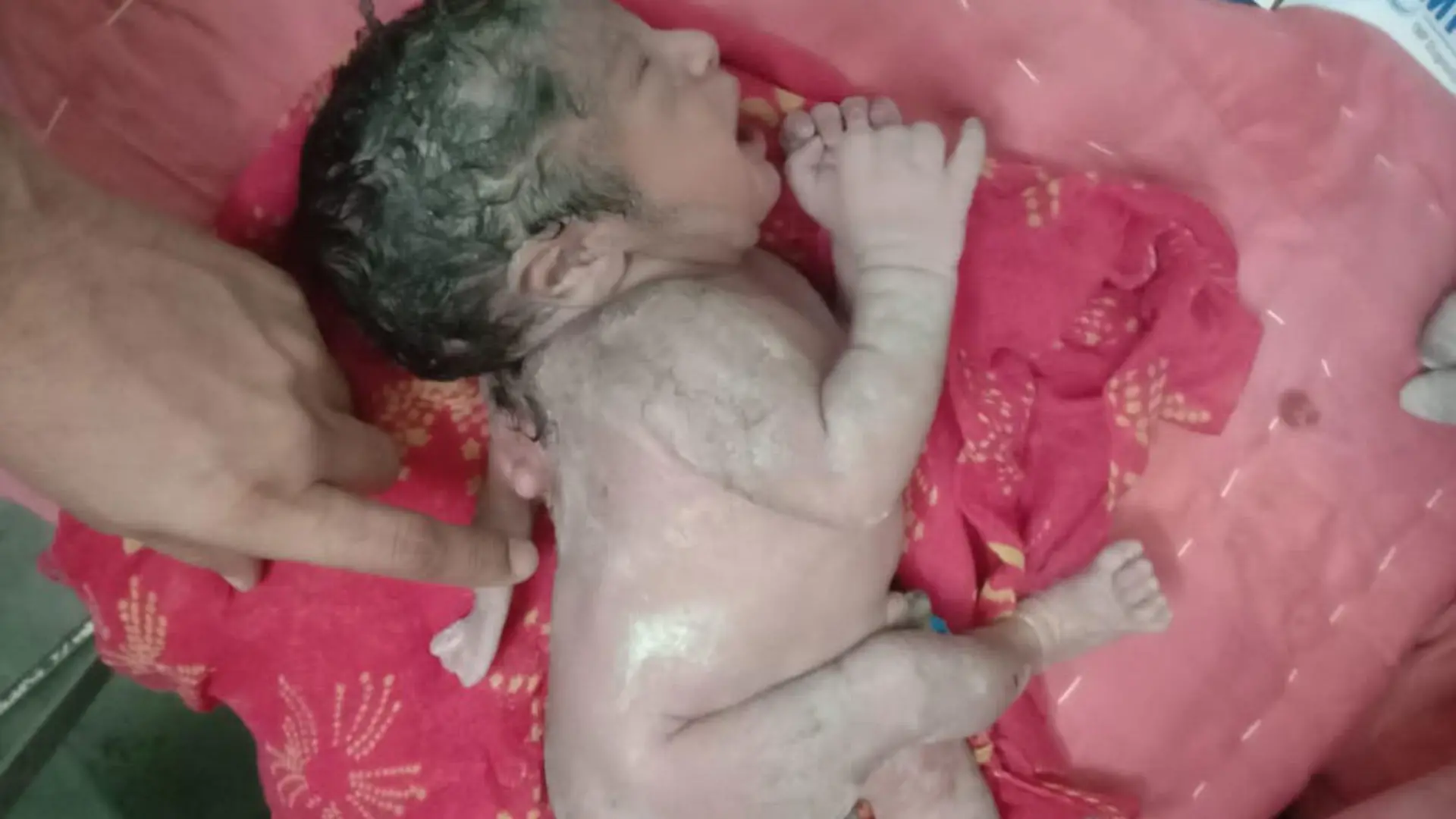 Story from Jam Press (Three Hands)
Pictured: The miracle baby born with three hands.
VIDEO: Miracle baby born with THREE hands.
A miracle baby has been born with THREE hands.
The newborn has two mitts in the normal places plus one of which is located on his back.
The baby has not been named by mother Suman.
It is her first child.
The third hand of the newborn is between the shoulder and the back.
As of now, doctors have confirmed the baby is healthy.
This unique child has been born in Nohar town of Hanumangarh district of Rajasthan, India.
Many rushed to the hospital to see the child after the birth.
Dr Hansraj Sharma, who delivered the child, said that this type of congenital malformation is called polymelia.
Doctors have referred the child for further treatment.
According to doctors, a similar case occurred in 2016 in Nepal but this is the first case in Rajasthan.
ENDS