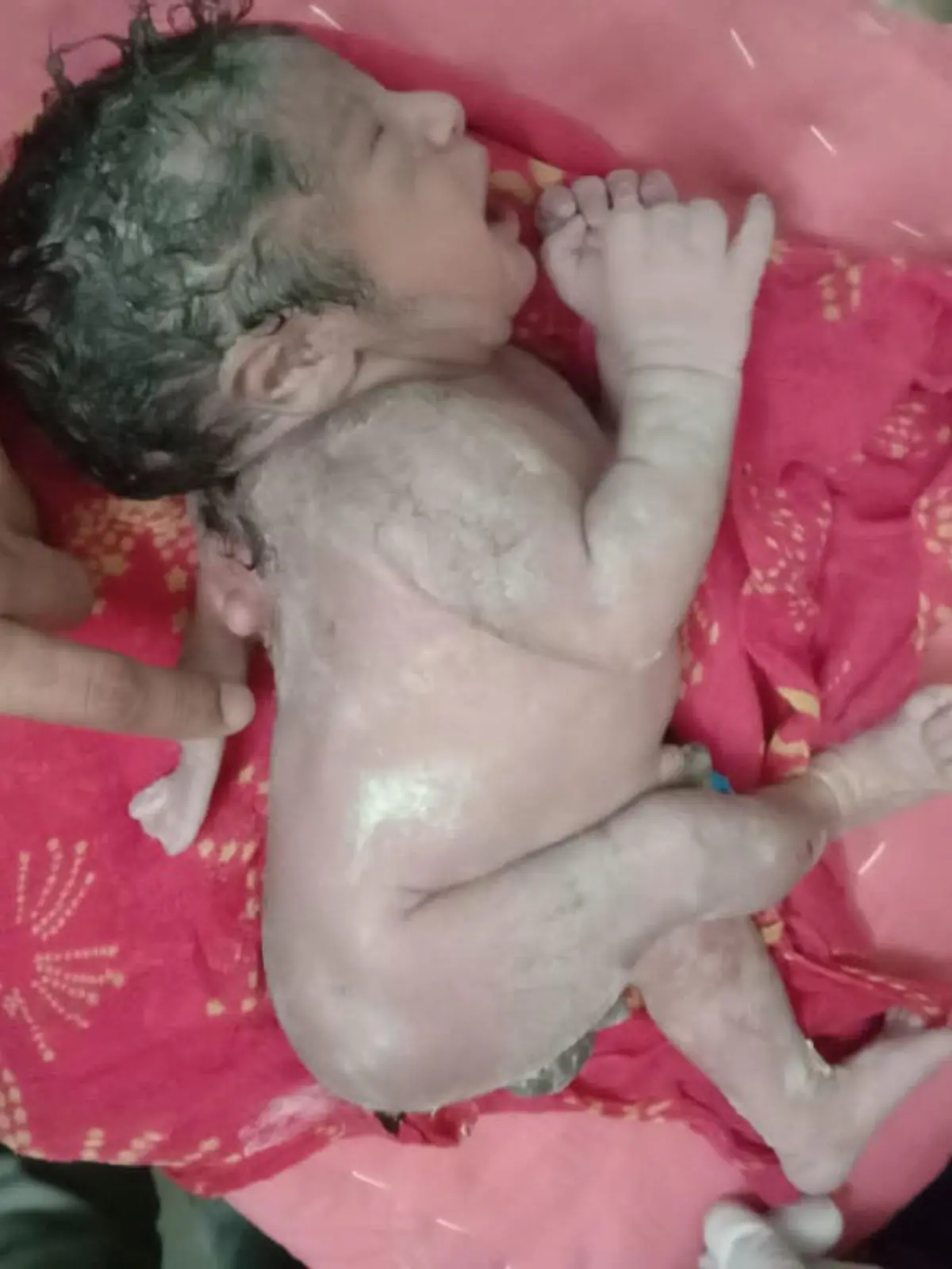 Story from Jam Press (Three Hands)

Pictured: The miracle baby born with three hands.

VIDEO: Miracle baby born with THREE hands.

A miracle baby has been born with THREE hands.

The newborn has two mitts in the normal places plus one of which is located on his back.

The baby has not been named by mother Suman.

It is her first child.

The third hand of the newborn is between the shoulder and the back.

As of now, doctors have confirmed the baby is healthy.

This unique child has been born in Nohar town of Hanumangarh district of Rajasthan, India.

Many rushed to the hospital to see the child after the birth.

Dr Hansraj Sharma, who delivered the child, said that this type of congenital malformation is called polymelia.

Doctors have referred the child for further treatment.

According to doctors, a similar case occurred in 2016 in Nepal but this is the first case in Rajasthan.

ENDS