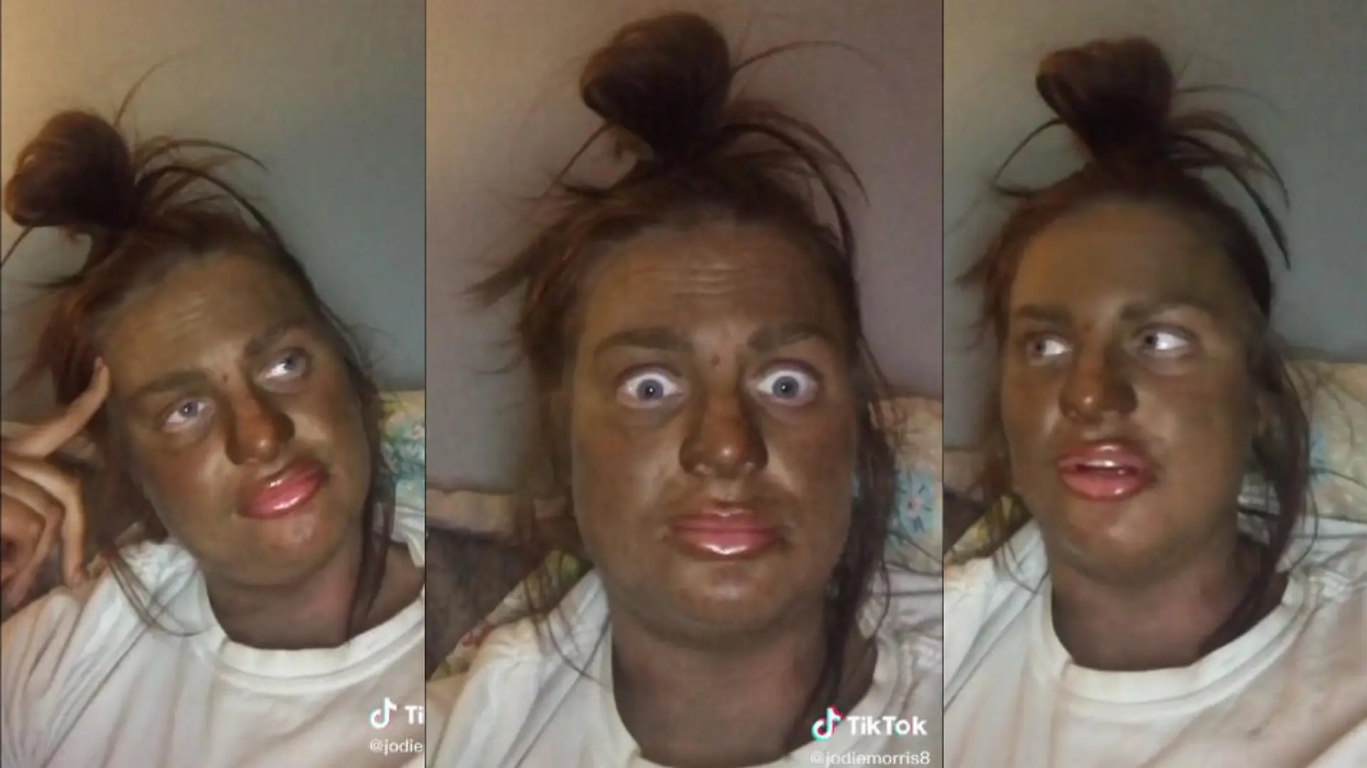Jodie Morris aus Leeds mit Selbstbräuner-Fail im Gesicht
