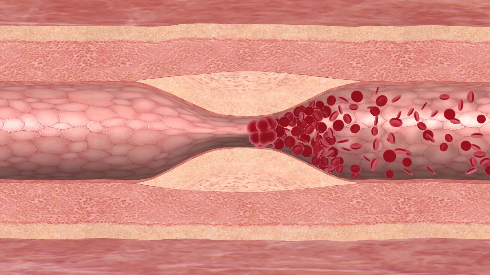 Das Bild zeigt ein Blutgerinnsel, das sich durch eine Engstelle in der Arterie gebildet hat. Der gestaute Blutstrom bildet einen Thrombus, der zum Gefäßverschluss führt.