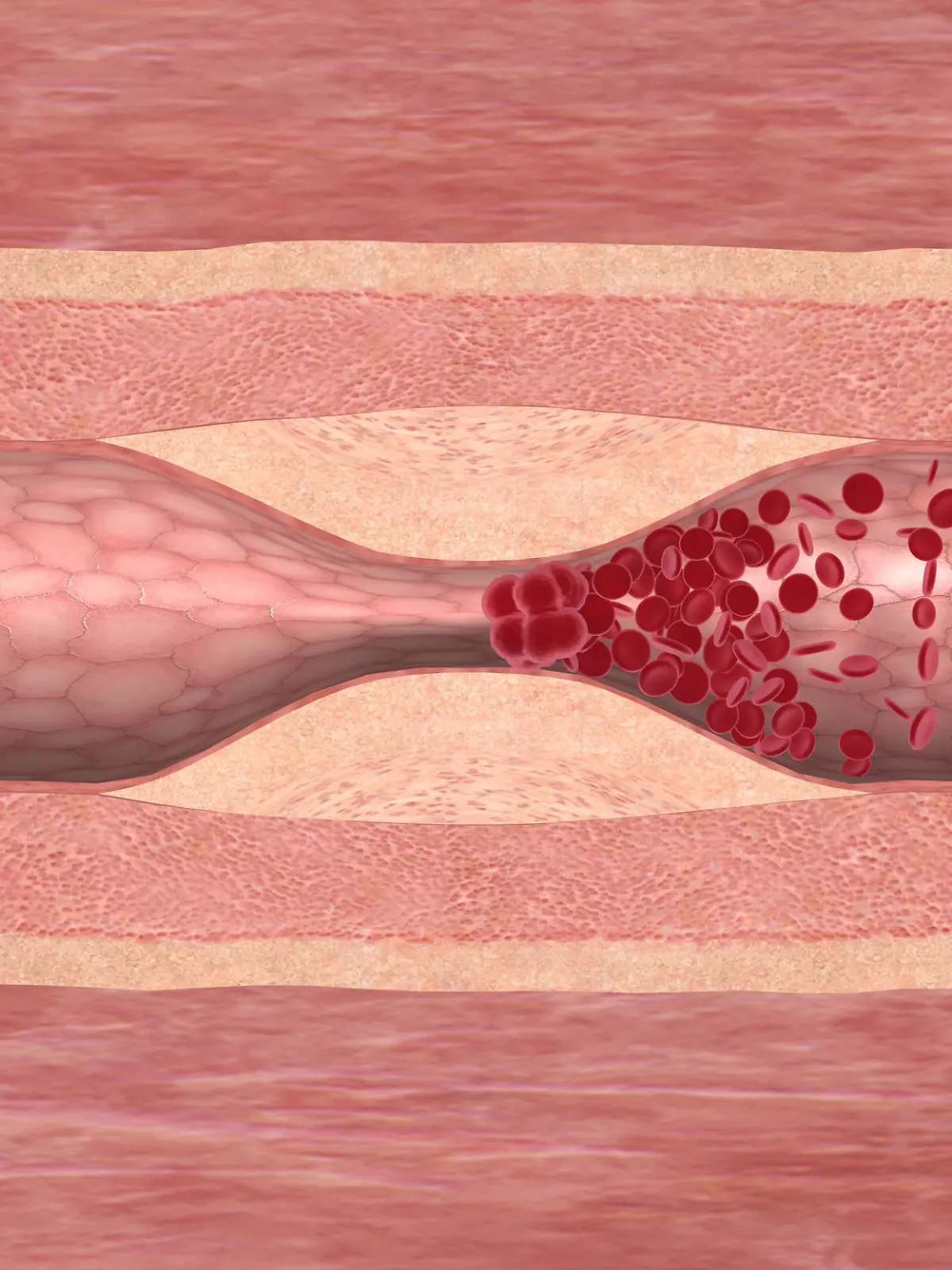 Das Bild zeigt ein Blutgerinnsel, das sich durch eine Engstelle in der Arterie gebildet hat. Der gestaute Blutstrom bildet einen Thrombus, der zum GefÃ¤ÃŸverschluss fÃ¼hrt.