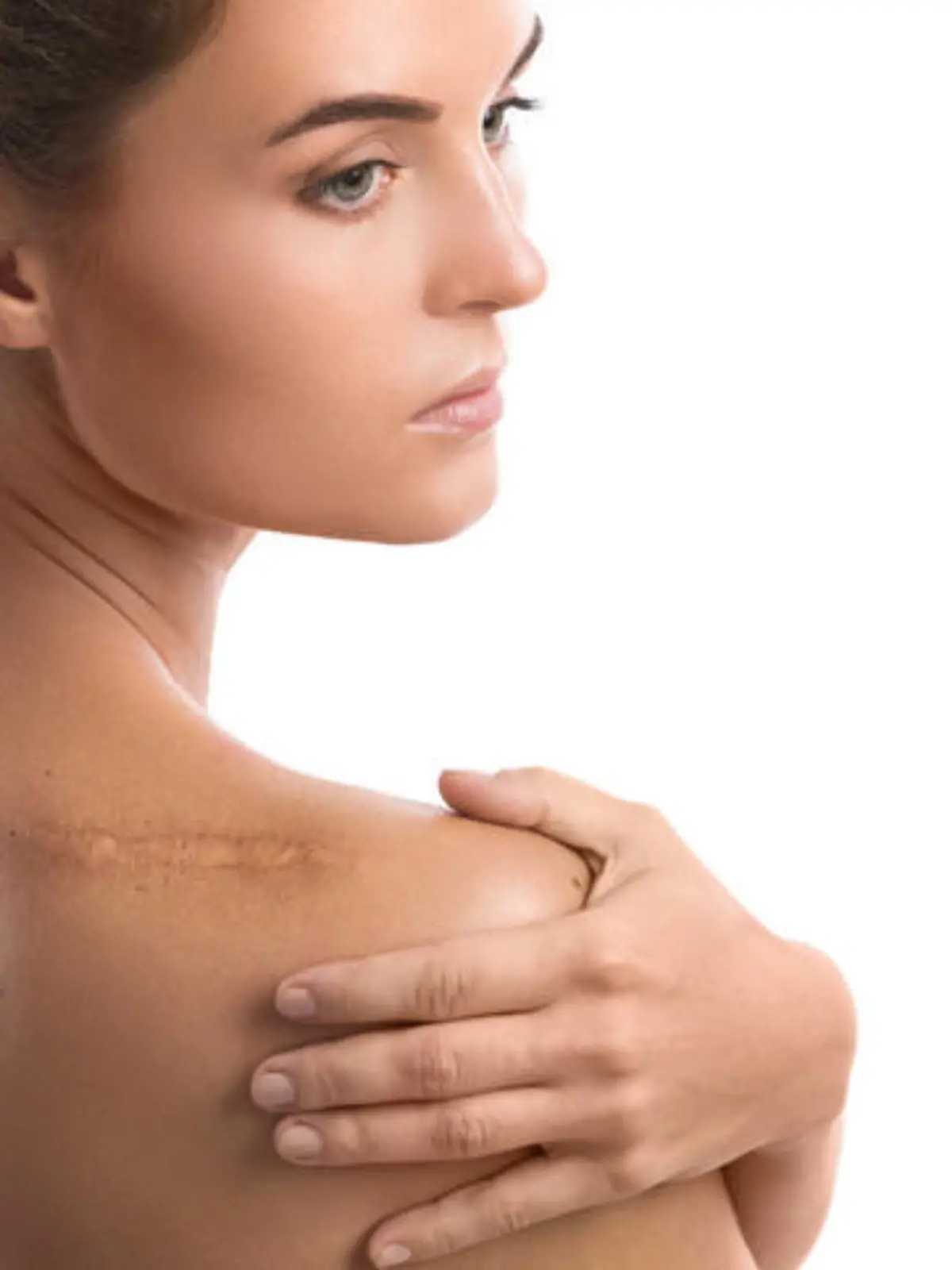 Woman with a scar on her shoulder over white background