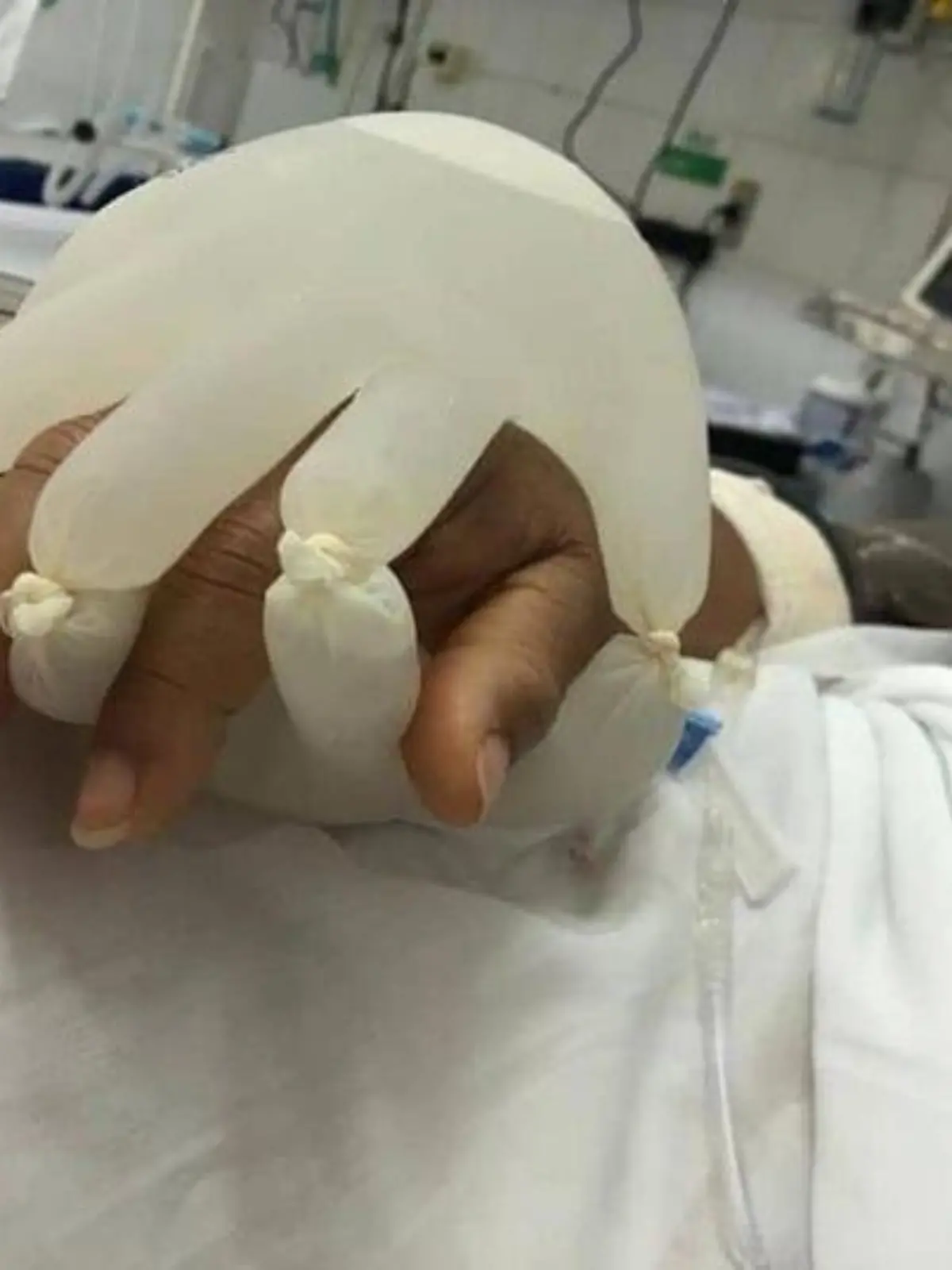 Mit Wasser gefüllte Handschuhe umschließen die Hand eines Patienten im Krankenhaus.