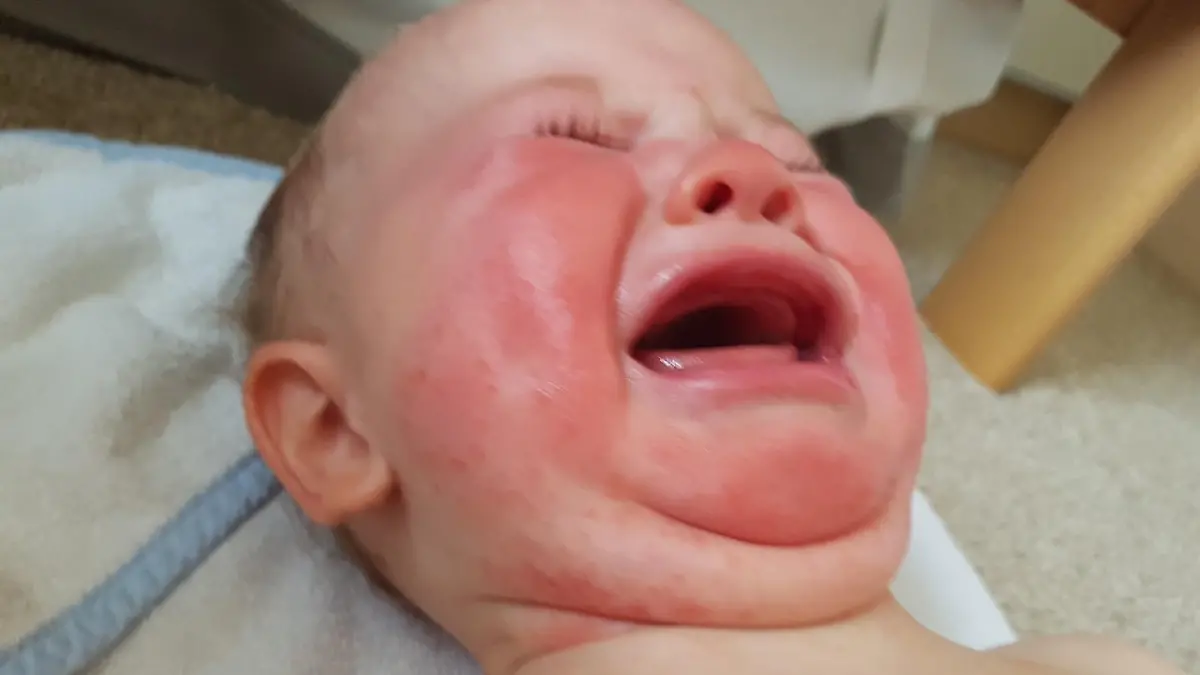 Baby Ayla hat Hautausschlag im Gesicht