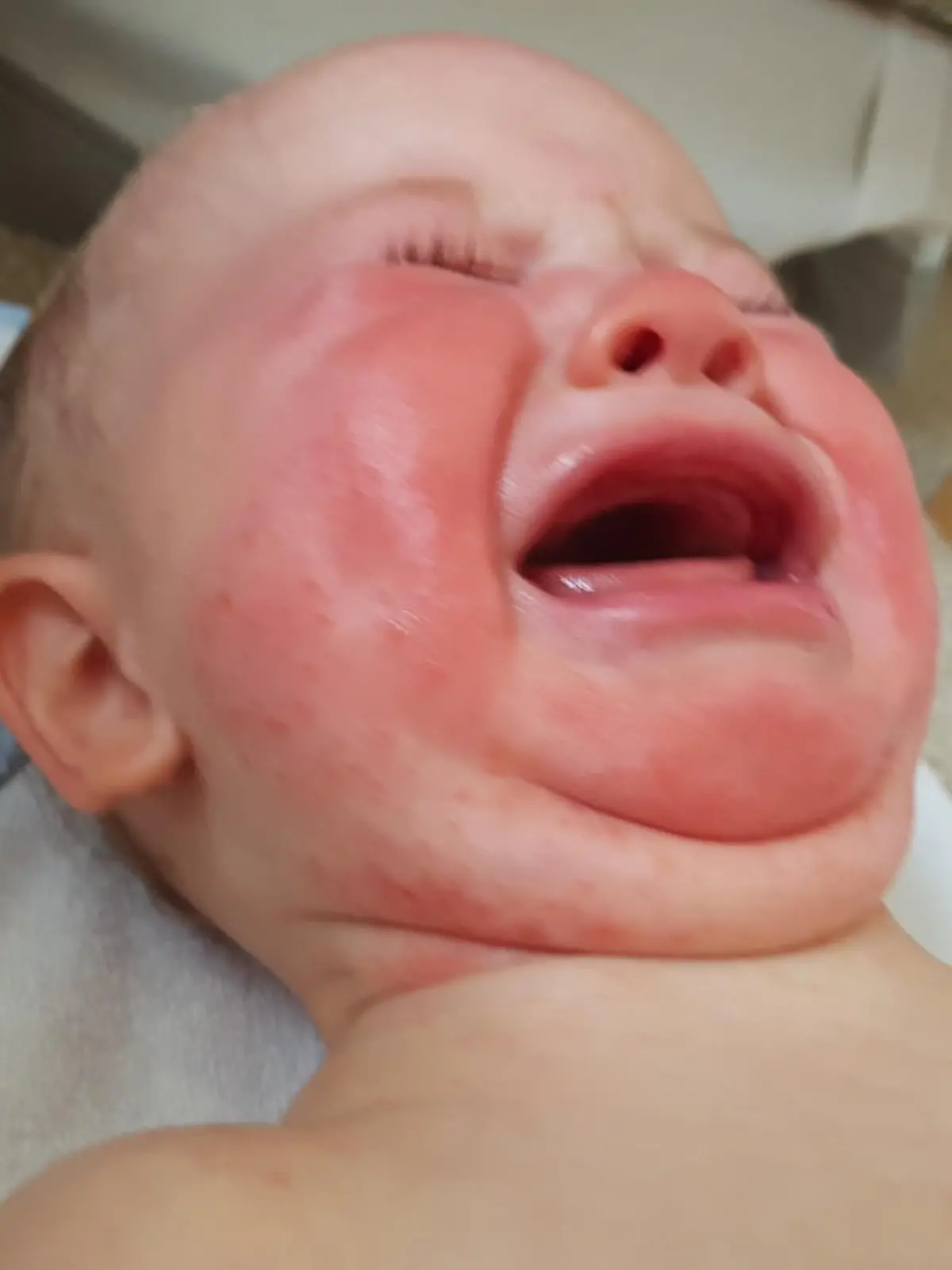 Baby Ayla hat Hautausschlag im Gesicht