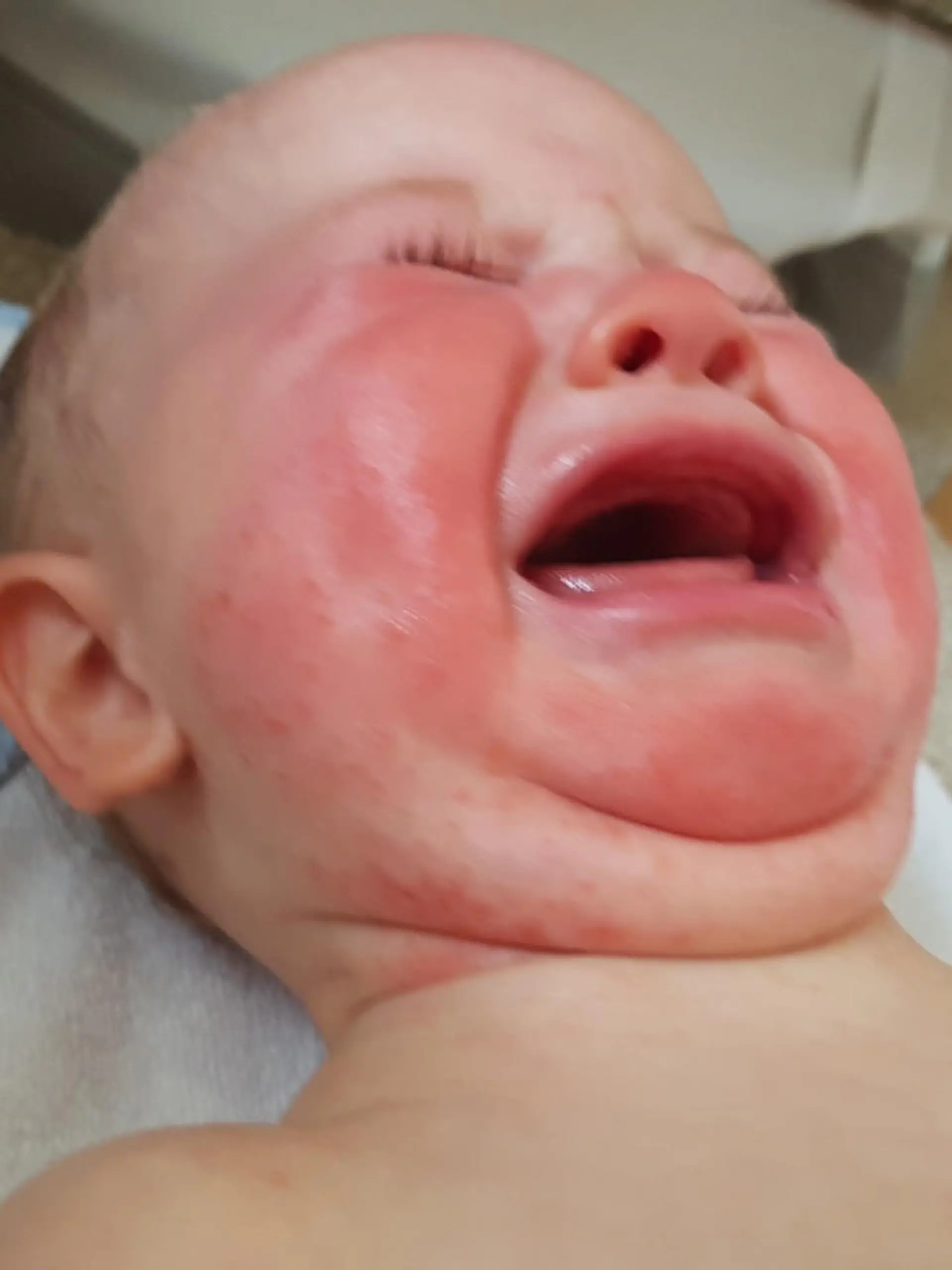 Baby Ayla hat Hautausschlag im Gesicht