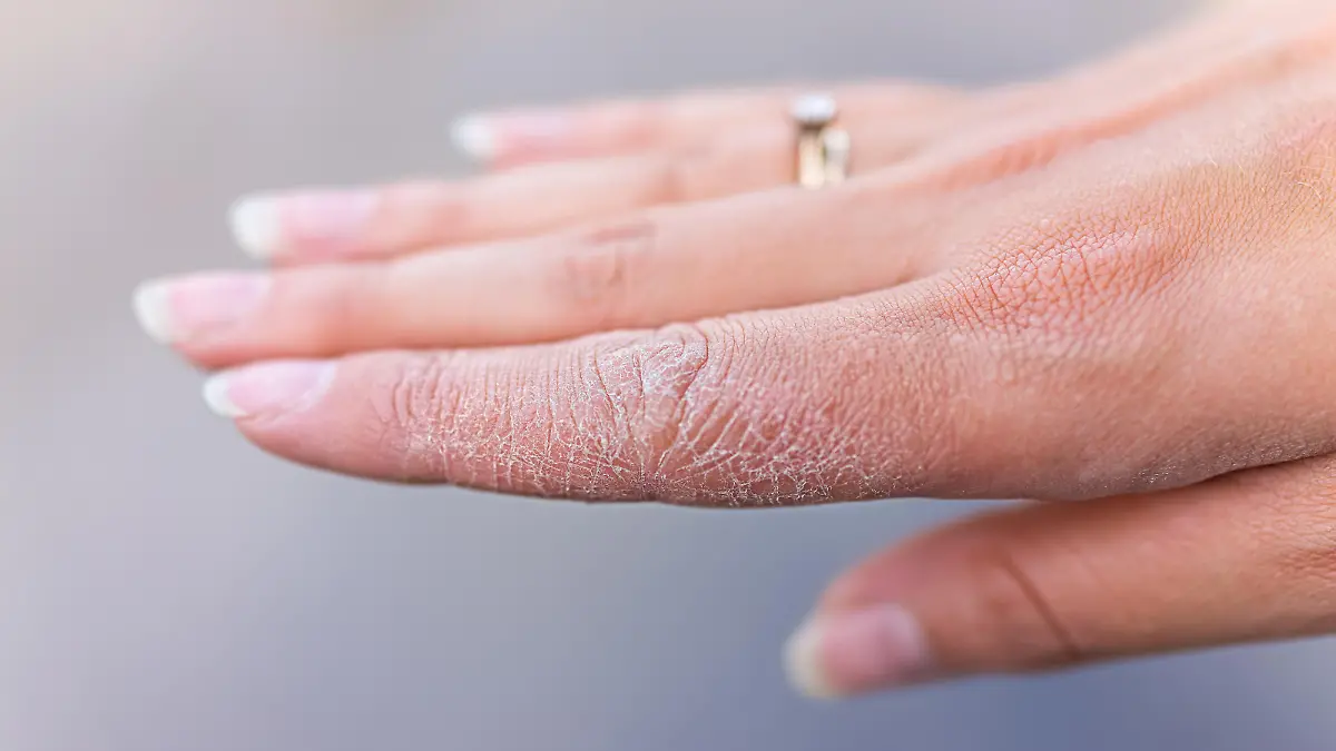 Zu viel Hände waschen führt zu trockener und entzündeter Haut.