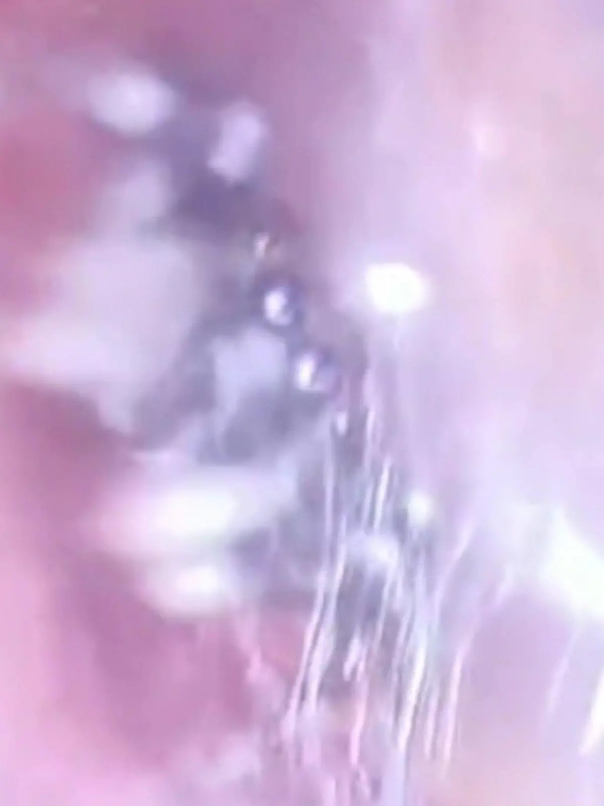 Das hier ist kein Trommelfell, sondern ein Spinnennetz! Eine Frau aus China beklagte sich über ein Vibrieren in ihrem Ohr.  Als die Ärzte dann mit einer Pinzette in den Gehörgang gehen, springt ihnen dieses kleine Insekt entgegen. Die Spinne sei nicht giftig gewesen. Die Frau habe nur leichte Schäden am Gehörgang davongetragen. Wie das Tier dort hineinkam ist nicht bekannt – egal, hauptsache die Spinne ist wieder draußen!