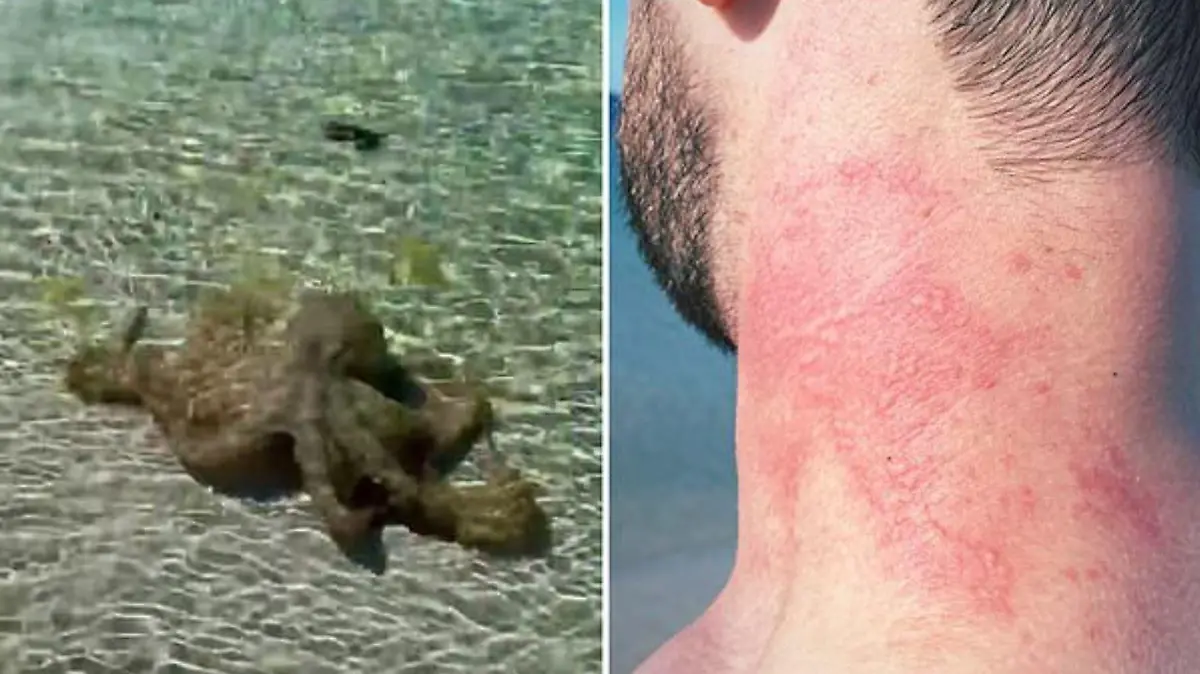 Der Oktopus hinterließ Lance Karlson mit diesen roten Abdrücken an Arm, Hals und Rücken.