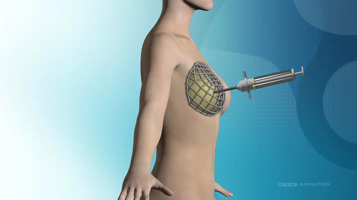 Es wird eine Art Gitter gebildet, das dann in den Körper kommt. Danach werden die Hohlräume mit körpereigenem Fett aufgefüllt.