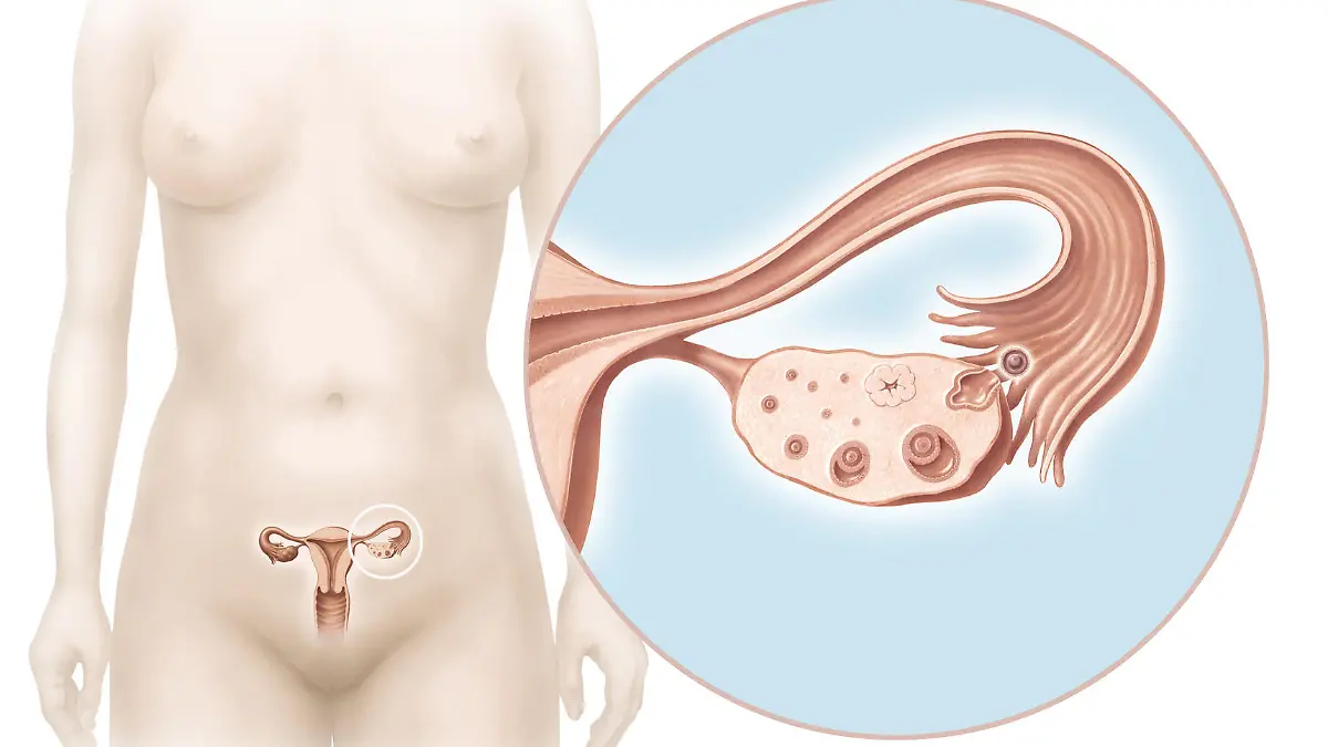Frauenkörper mit Uterus und Ovarien, Nahansicht eines Ovariums mit sichtbarem Eisprung
