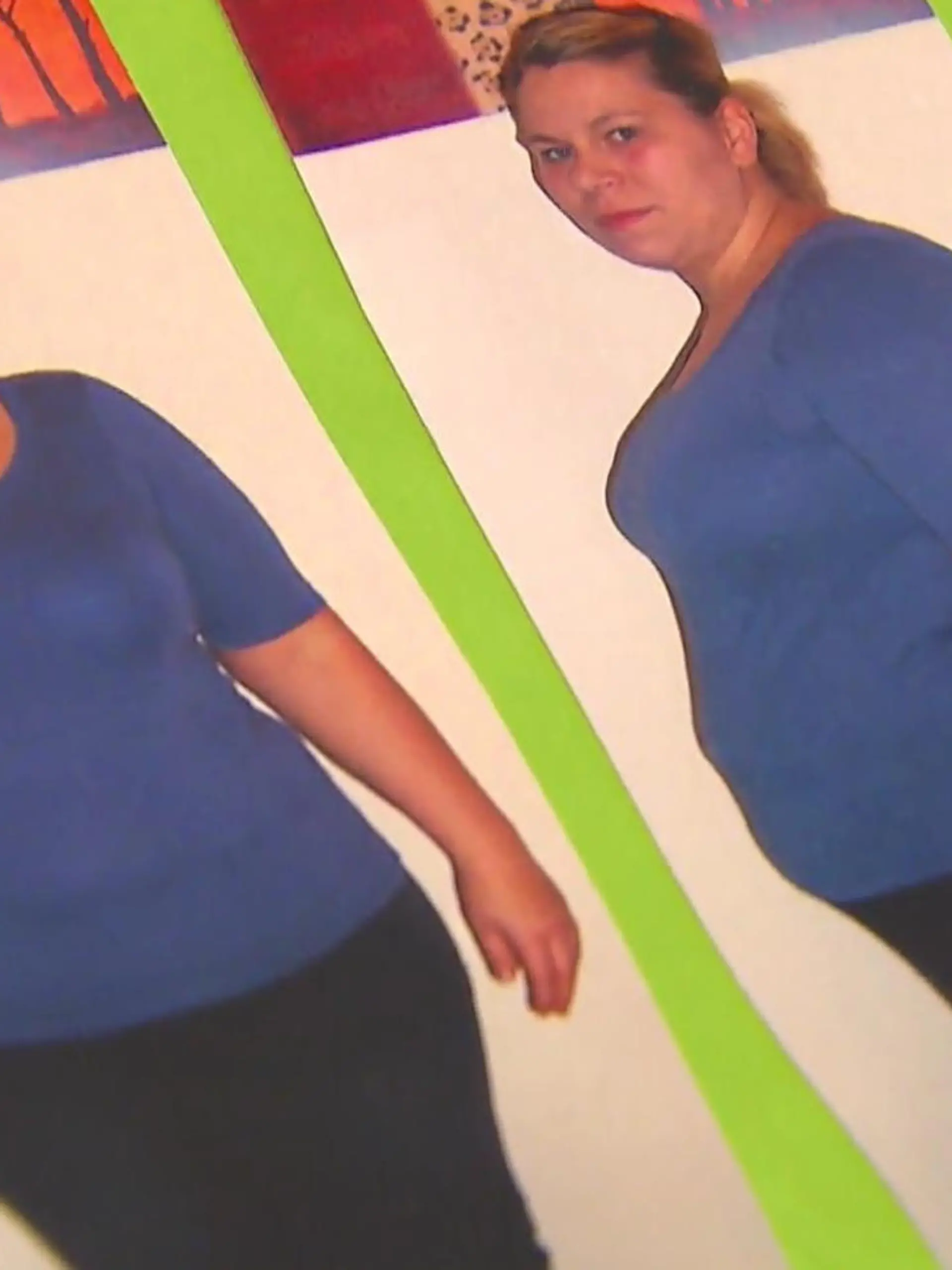 Nach einer Magenbypass-OP leidet die ehemals 130 Kilo schwere Dreifach-Mama unter starken Schmerzen und kämpft mittlerweile sogar mit Unter- statt Übergewicht.