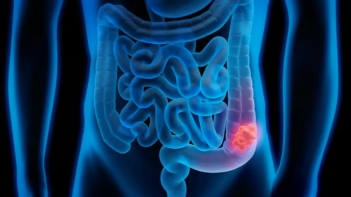 Medical illustration of Colorectal Cancer - Polyp