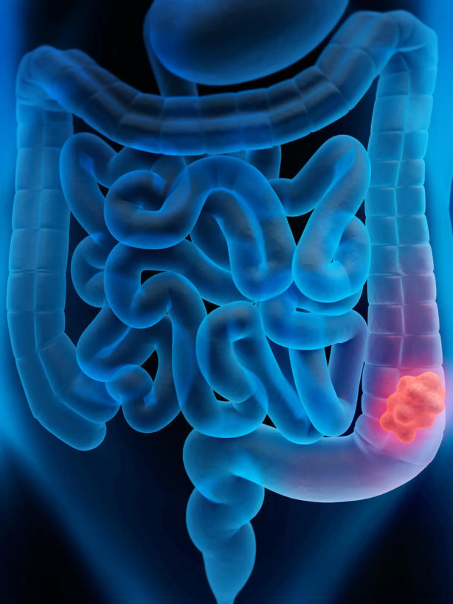 Medical illustration of Colorectal Cancer - Polyp