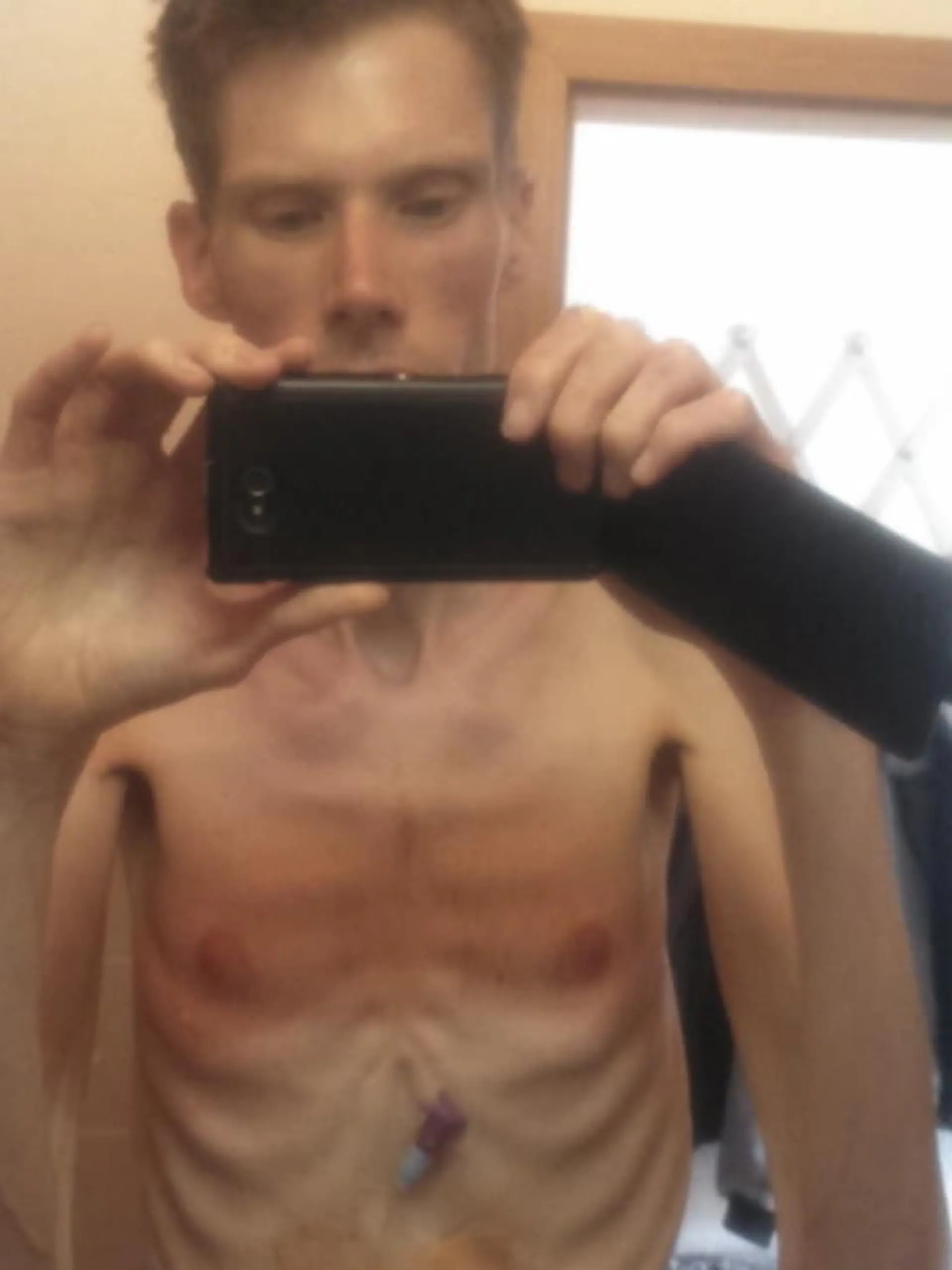 Es ist ein Tabuthema: Magersucht. Und das erst recht, wenn es Männer betrifft. Der über ein Meter neunzig große Markus aus Herne wog nur noch 38 Kilo. Und trotzdem wollte er die Krankheit nicht wahrhaben. Es wurde sogar so schlimm, dass die Ärzte ihm keine Überlebenschance mehr gaben. Doch dann die Sensation: Er bekommt die Kurve. Wir haben ihn getroffen und zeigen Ihnen im Video, wie er dieses Wunder geschafft hat.