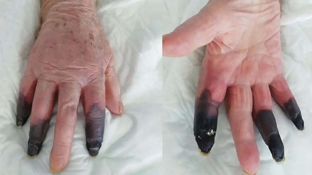 Gruselige Bilder. Drei Finger einer Frau haben sich schwarz gefärbt.
