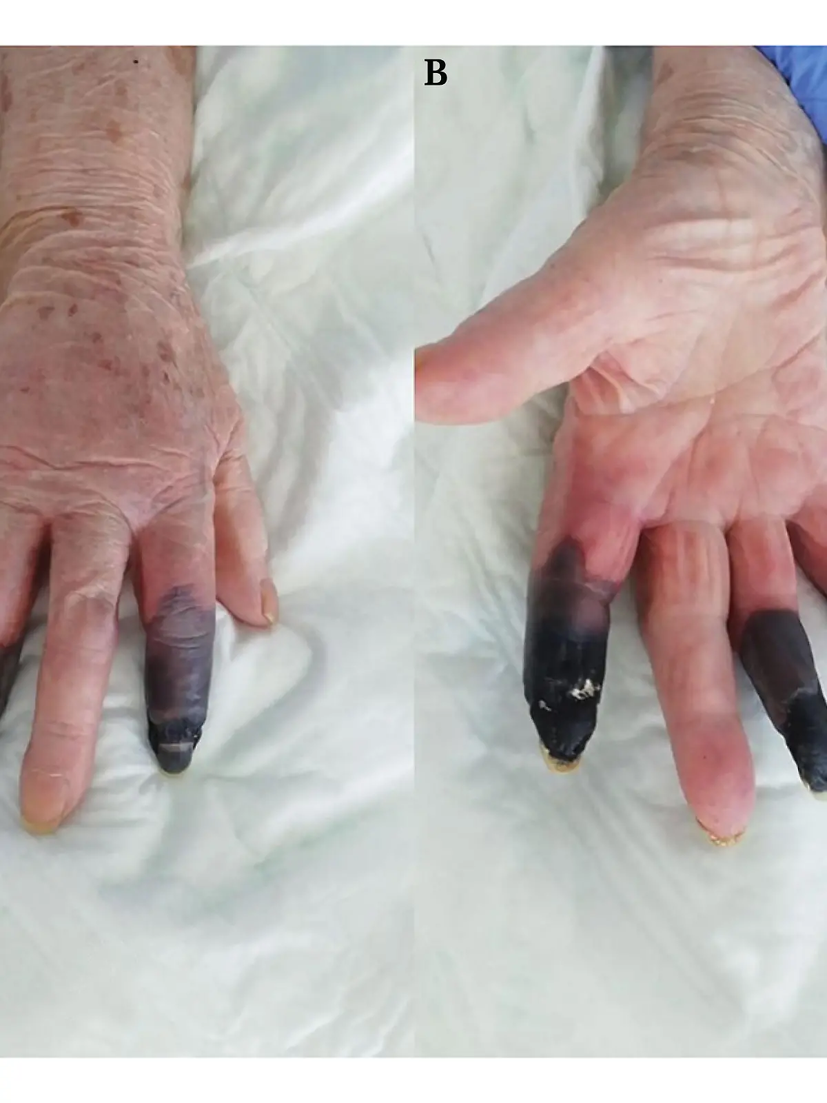Gruselige Bilder. Drei Finger einer Frau haben sich schwarz gefärbt.