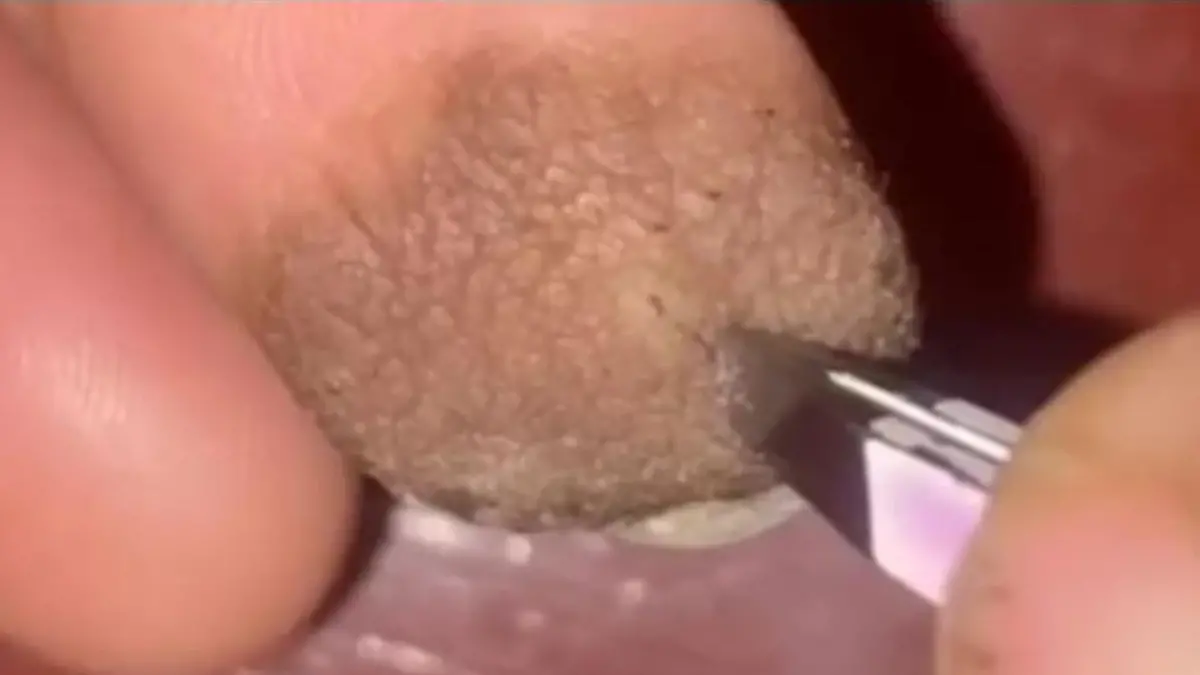 Rae zieht sich ein Haar aus der Fingerkuppe