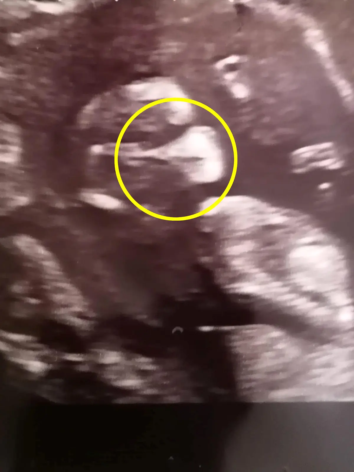 Samantha Spicers Baby scheint auf einem Ultraschallbild eine Maske zu tragen.