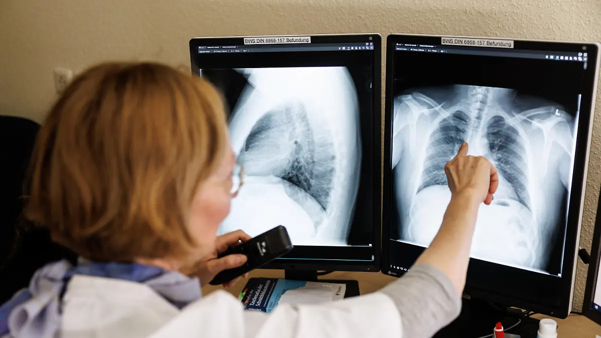 ARCHIV - 12.03.2022, Bayern, Gauting: Eine Radiologin analysiert in ihrem Büro in der Lungenklinik Gauting die Röntgenbilder der Lunge einer aus der Ukraine geflüchteten Person. Nach längerer rückläufiger Entwicklung ist die Zahl der gemeldeten Tuberkulose-Fälle (TB) in Deutschland im vergangenen Jahr auf niedrigem Niveau leicht angestiegen - wohl auch eine Folge des russischen Angriffskriegs in der Ukraine. (zu dpa «Tuberkulose-Fallzahlen in Deutschland leicht gestiegen») Foto: Matthias Balk/dpa +++ dpa-Bildfunk +++