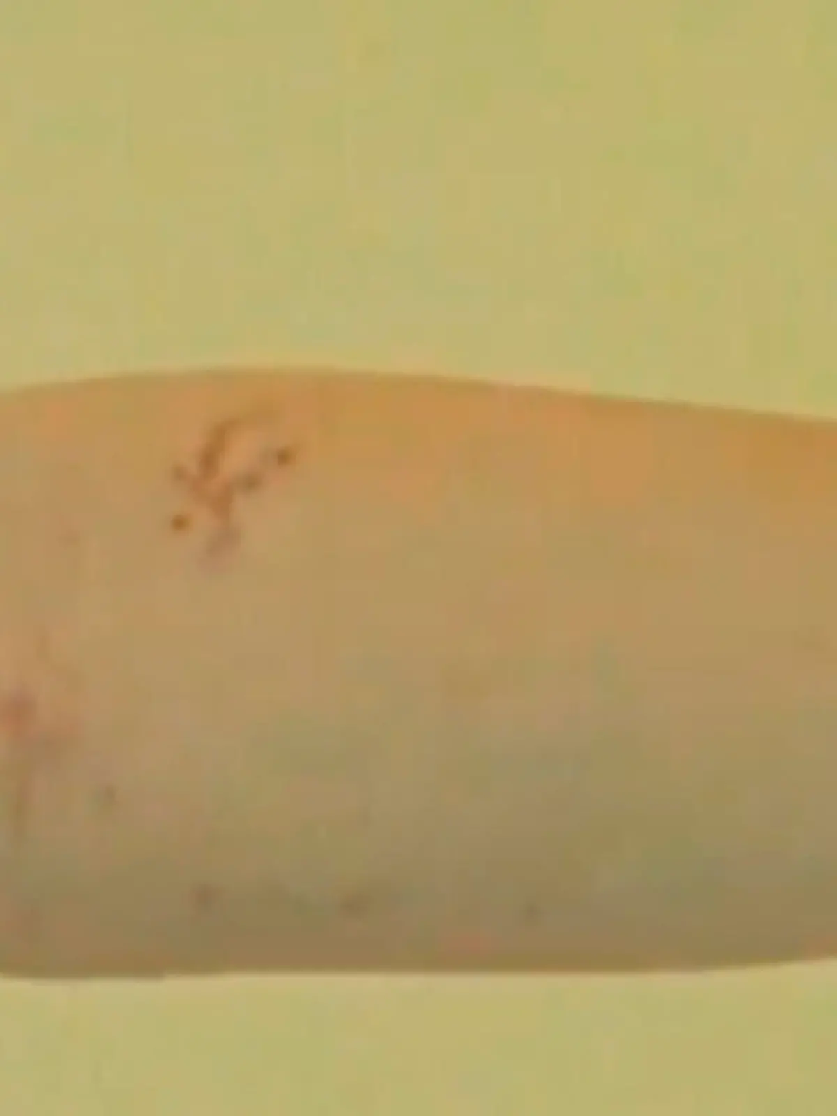 Hautirritationen, wie diese am Arm, können ein frühes Erkennungszeichen für eine Corona-Erkrankung sein