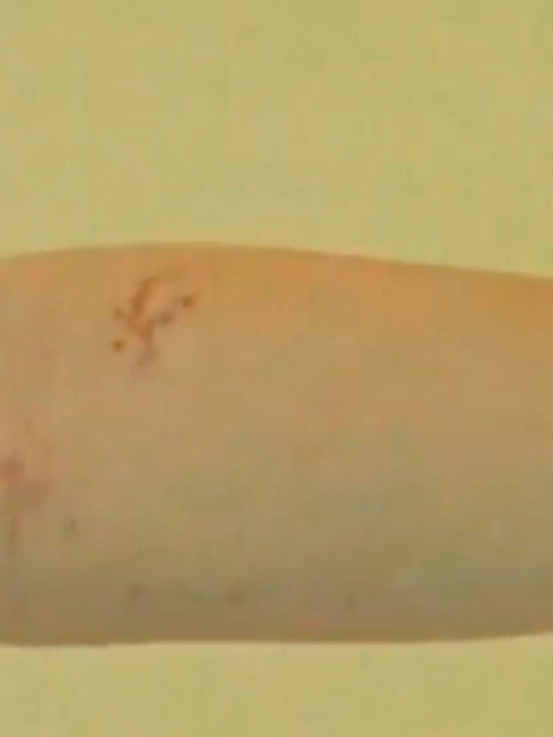 Hautirritationen, wie diese am Arm, können ein frühes Erkennungszeichen für eine Corona-Erkrankung sein
