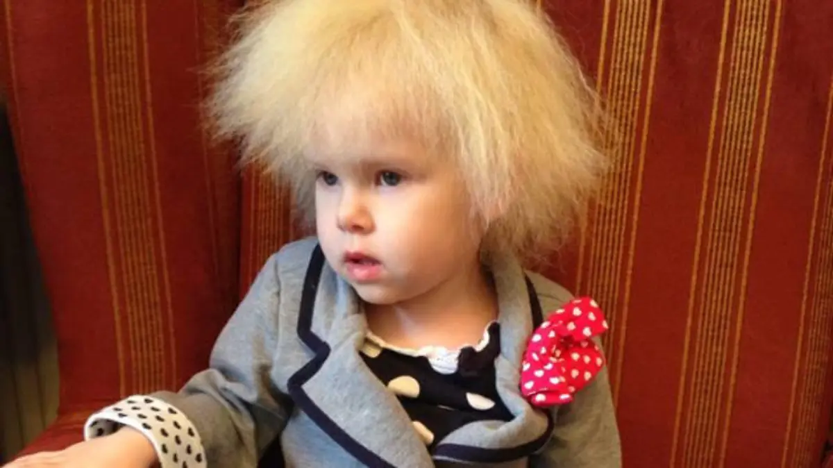Schmerzhaft! Fünfjährige leidet an dem Syndrom der unkämmbaren Haare - ***EMBARGOED UNTIL 3PM GMT 2 APRIL 2017***Little Lyla Grace Barlow, 5, has the very rare condition of uncombable hair syndrome, which makes it painful to brush her hair, pictured by her parents as shes grown up, March 30 2017. See South West copy SWALBERT: A five-year-old girl has the same gravity-defying hair as Albert Einstein thanks to a rare genetic condition - which means her locks are IMPOSSIBLE to brush. Adorable Lyla-Grace Barlow's static white mane is a result of Uncombable Hair Syndrome, which is known to affect just 100 people worldwide. The condition is caused by a mutated gene which creates abnormal heart-shaped hair follicles instead of round ones. It means little Lyla's fluffy locks stand constantly on end and refuse to be tamed - earning her the nickname 'the Candyfloss child'.