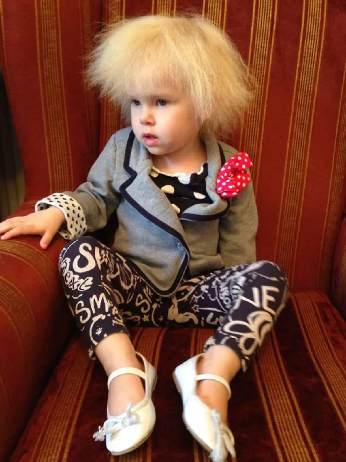 Schmerzhaft! Fünfjährige leidet an dem Syndrom der unkämmbaren Haare - ***EMBARGOED UNTIL 3PM GMT 2 APRIL 2017***Little Lyla Grace Barlow, 5, has the very rare condition of uncombable hair syndrome, which makes it painful to brush her hair, pictured by her parents as shes grown up, March 30 2017. See South West copy SWALBERT: A five-year-old girl has the same gravity-defying hair as Albert Einstein thanks to a rare genetic condition - which means her locks are IMPOSSIBLE to brush.  Adorable Lyla-Grace Barlow's static white mane is a result of Uncombable Hair Syndrome, which is known to affect just 100 people worldwide. The condition is caused by a mutated gene which creates abnormal heart-shaped hair follicles instead of round ones. It means little Lyla's fluffy locks stand constantly on end and refuse to be tamed - earning her the nickname 'the Candyfloss child'.