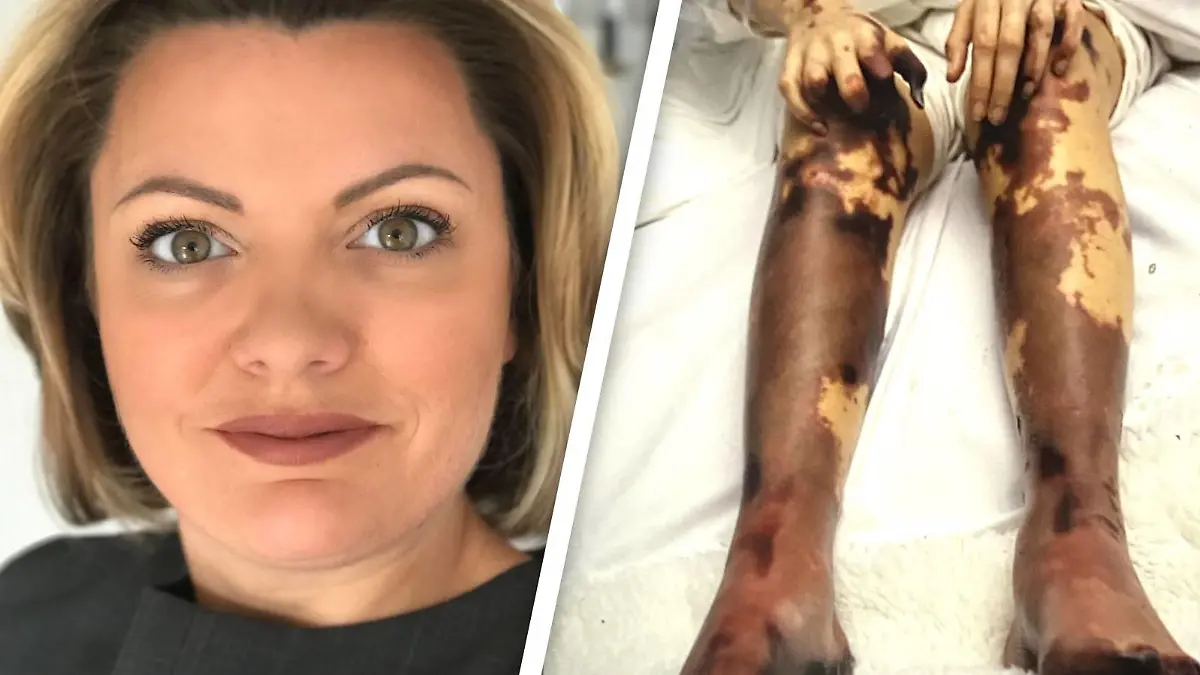Sophia Wyatt verlor beide Beine durch eine Meningitis-Erkrankung