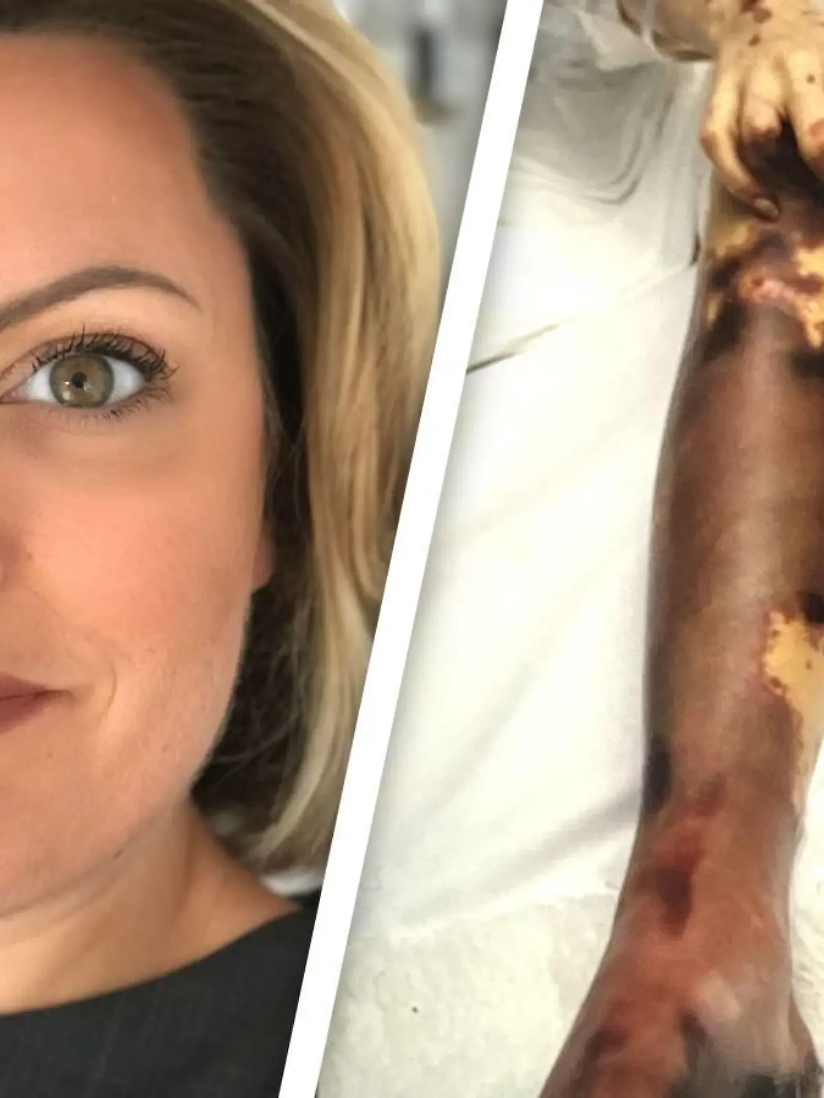 Sophia Wyatt verlor beide Beine durch eine Meningitis-Erkrankung