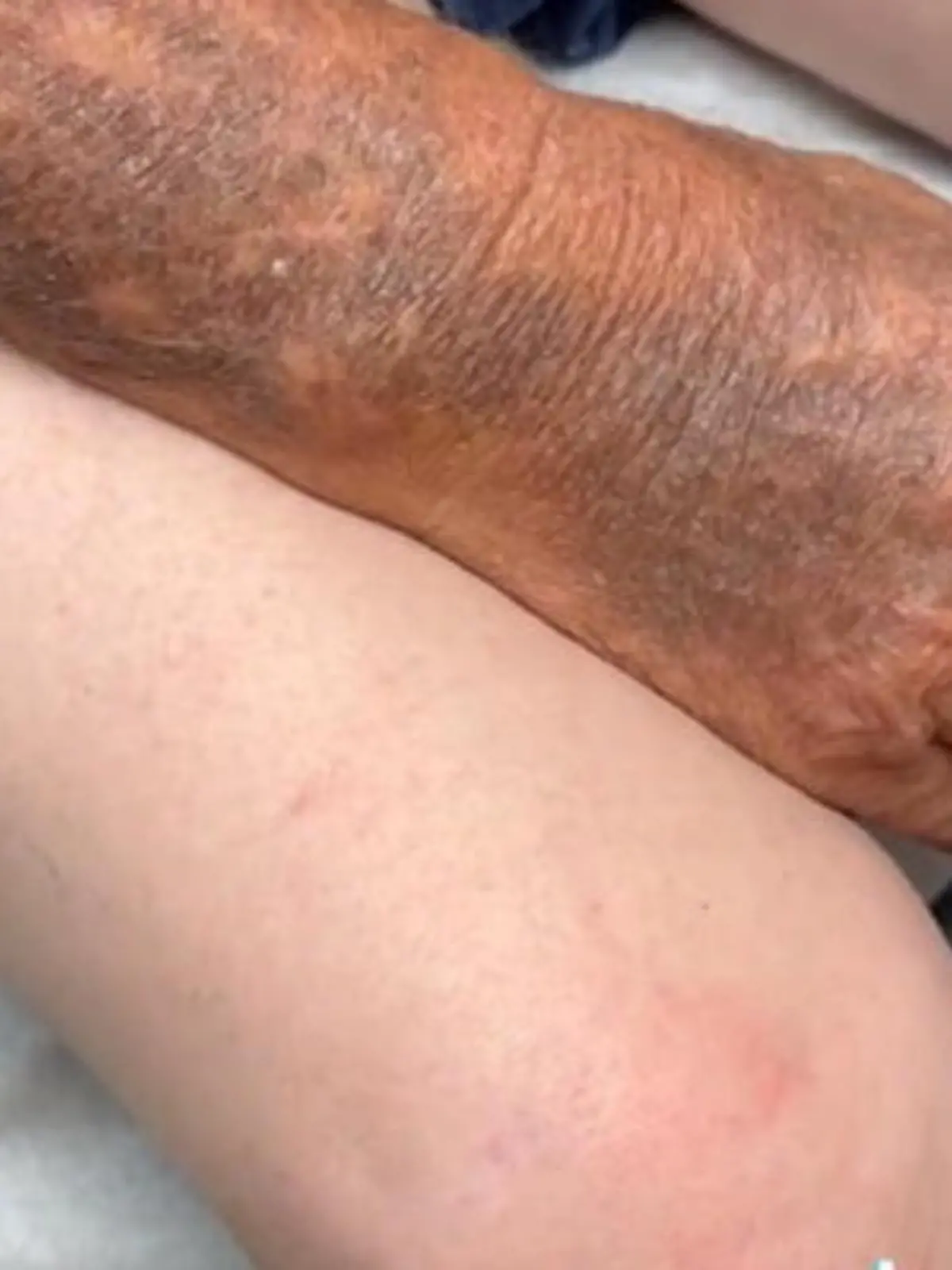 Was sie hier sehen, ist das Resultat von 70 Jahren Arbeit in der Sonne. Die Arme des Mannes im Video sehen aus, als würden sie zu einem anderen Paar Beine gehören – denn so große Unterschiede im Teint haben wir noch nie gesehen!
