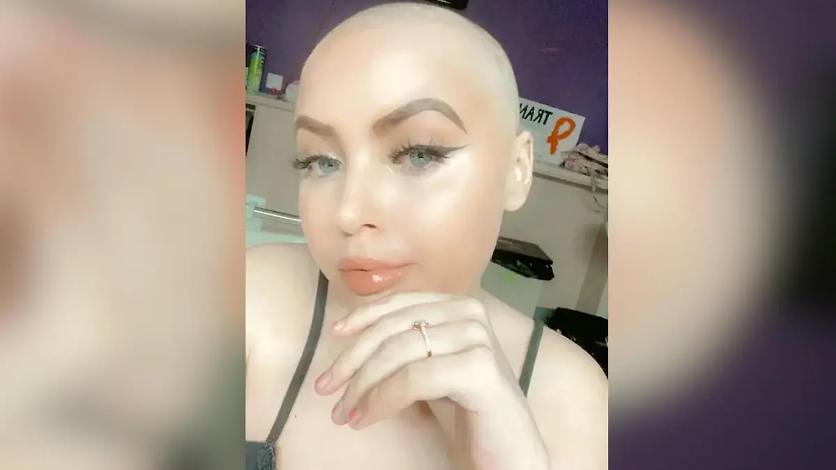SONDERKONDITIONEN: Satzpreis! Chloe after losing her hair. See SWNS story SWSMtransplant. A woman who was told she had tonsillitis correctly diagnosed herself with leukaemia - using Google. Chloe-Leigh Todd, 22, started experiencing a sore throat and