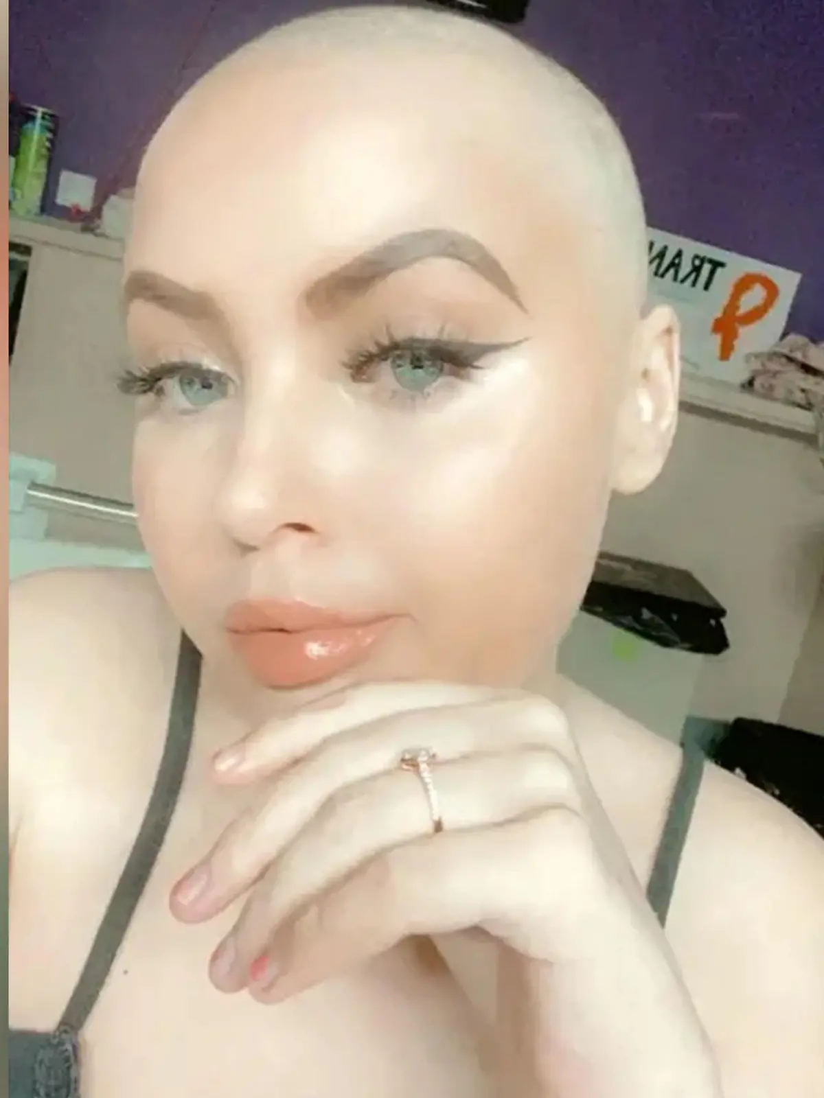 SONDERKONDITIONEN: Satzpreis! Chloe after losing her hair. See SWNS story SWSMtransplant. A woman who was told she had tonsillitis correctly diagnosed herself with leukaemia - using Google. Chloe-Leigh Todd, 22, started experiencing a sore throat and