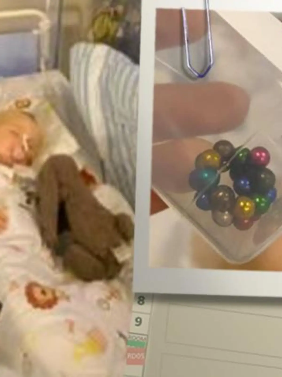 Die kleine Mille hatte 21 Magnet-Kügelchen runtergeschluckt.