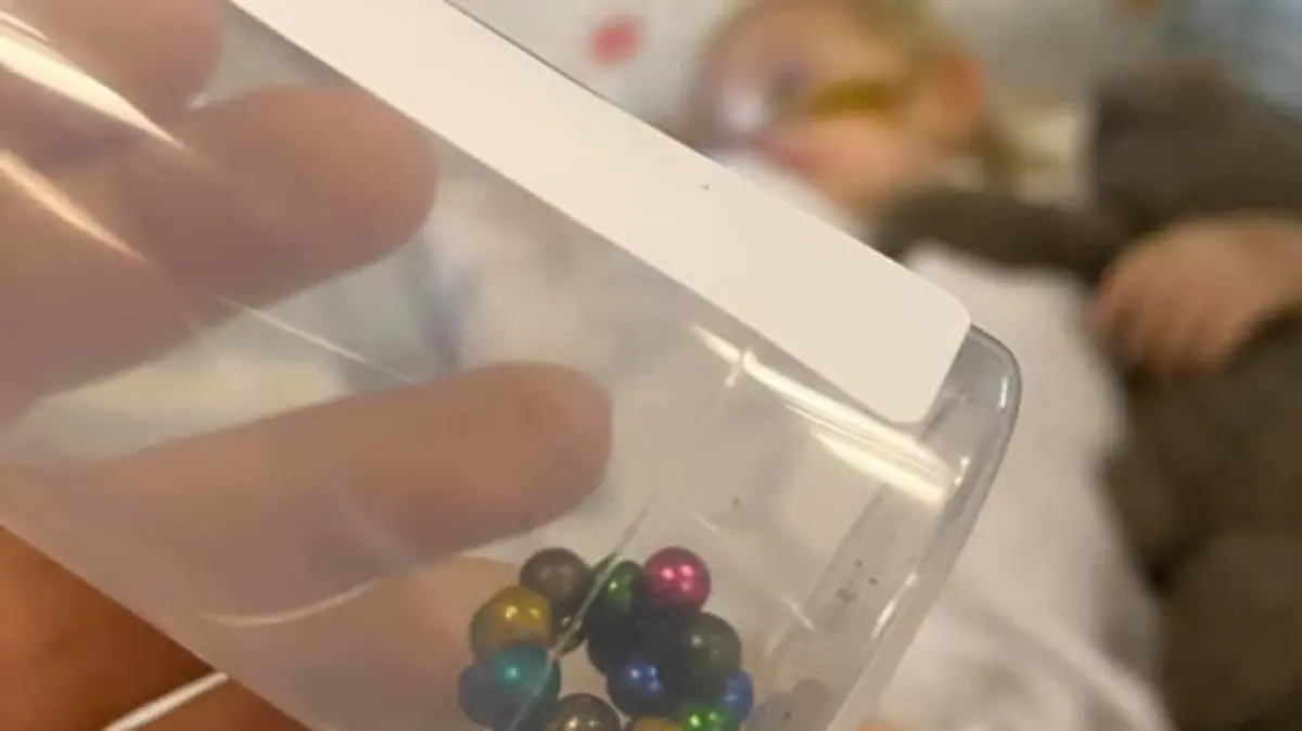 Diese kleinen Magnet-Kügelchen wurden aus Milles Körper herausoperiert.