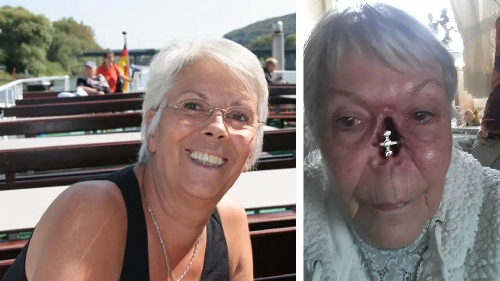 Rechts sieht man Ulrike als gesunde strahlende Frau. Links sieht man sie mit einem Loch im Gesicht, dort, wo ihre Nase einmal gewesen ist.