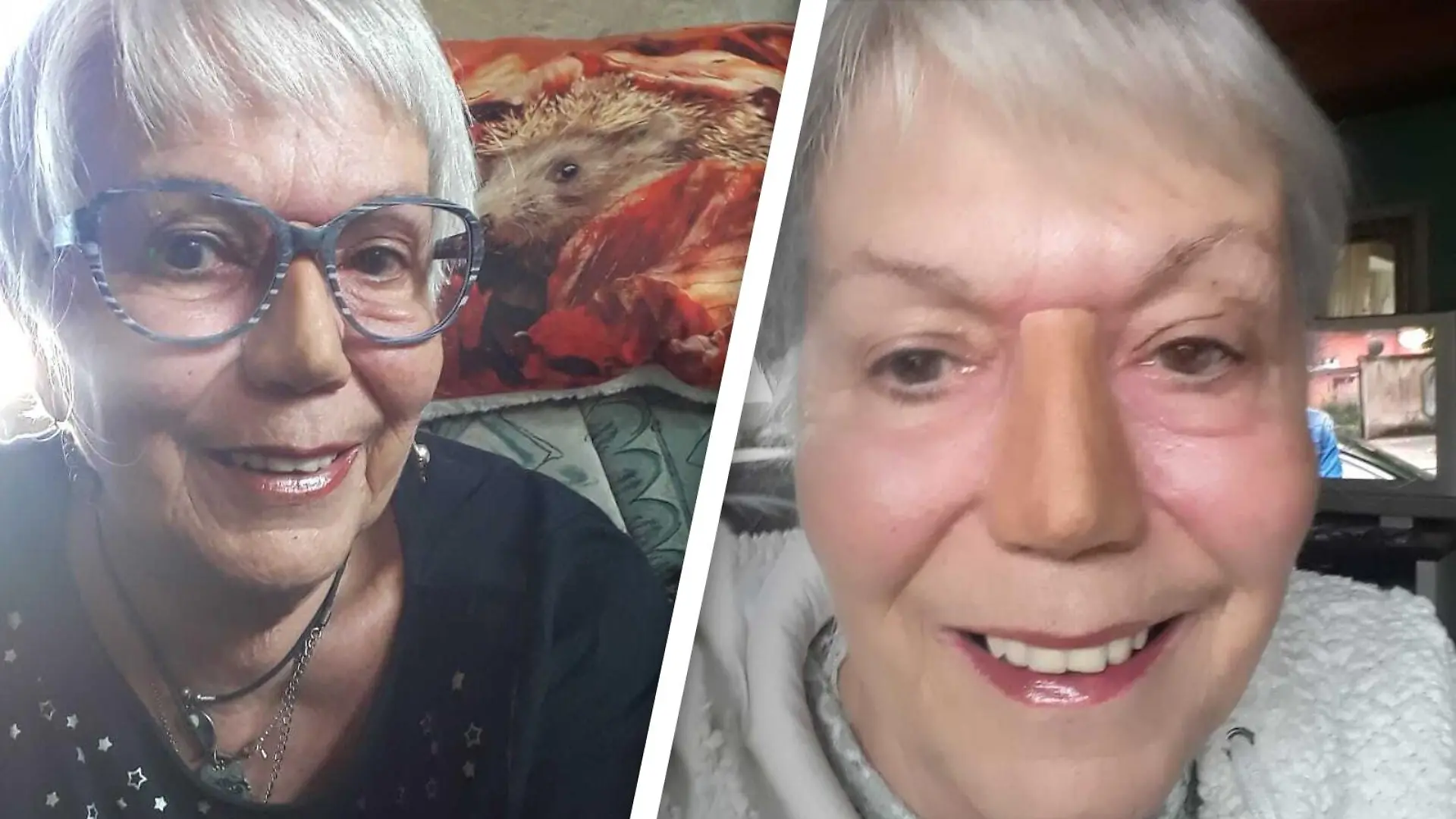 Auf dem linken Bild sieht man Ulrike mit ihrer Brille. Auf dem rechten Bild sieht man sie ohne Brille - dort erkennt man die Ränder ihrer künstlichen Nase.
