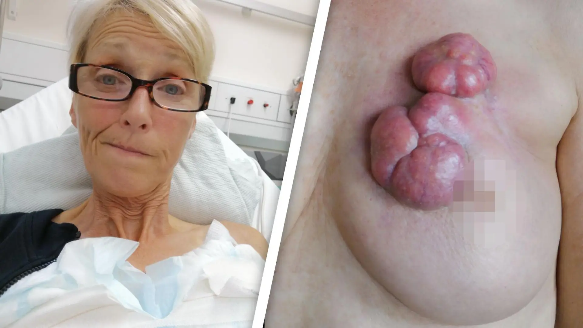 Nina Collins kämpft gegen Brustkrebs und sammelt Spenden für eine Behandlung ihrer tennisballgroßen Tumore