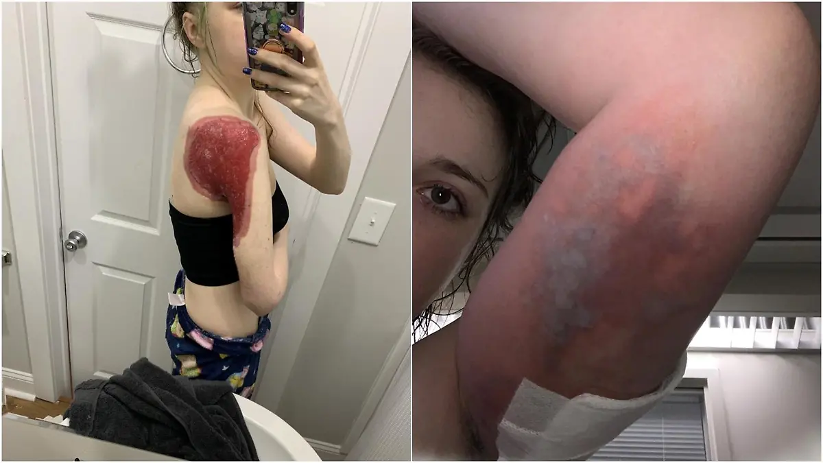 Carolina verlor nicht nur fast ihren Arm durch die Infektion, sondern ihr Leben.