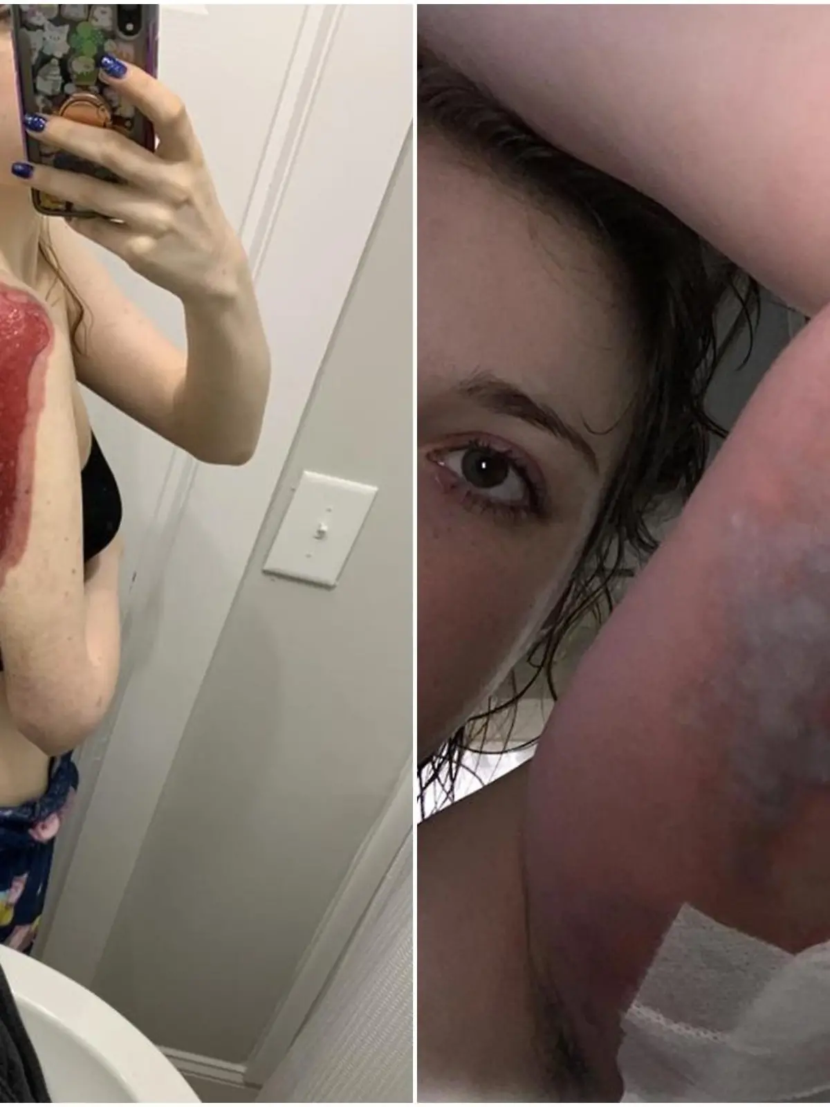 Carolina verlor nicht nur fast ihren Arm durch die Infektion, sondern ihr Leben.