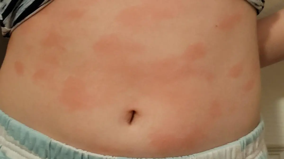 Danielles Haut, nach dem sie in Berührung mit Wasser kommt