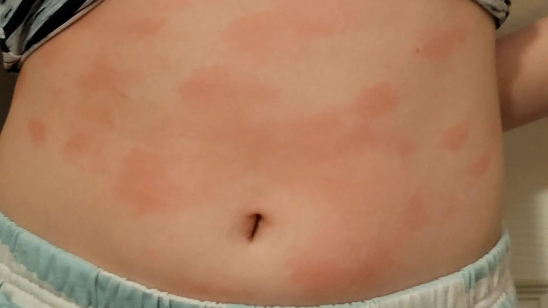 Danielles Haut, nach dem sie in Berührung mit Wasser kommt