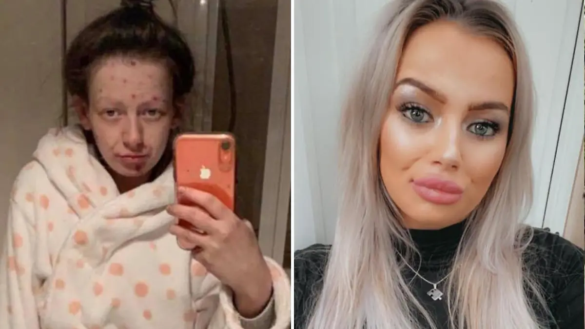 Zwei Jahre lang war Zweifach-Mama Demi-Nicole Dunlop aus dem schottischen Fochabers schwerst abhängig von Heroin und Crack. Die unglaublichen Bilder zeigen, wie gut sich die Studentin mittlerweile erholt hat.