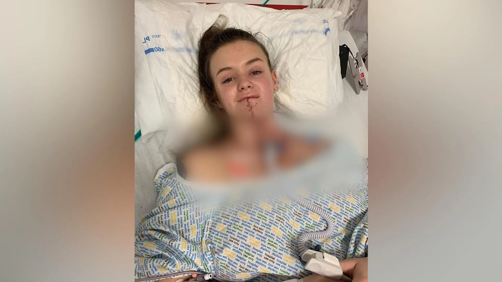 Rachel Morton nach ihrer Zungen-OP
