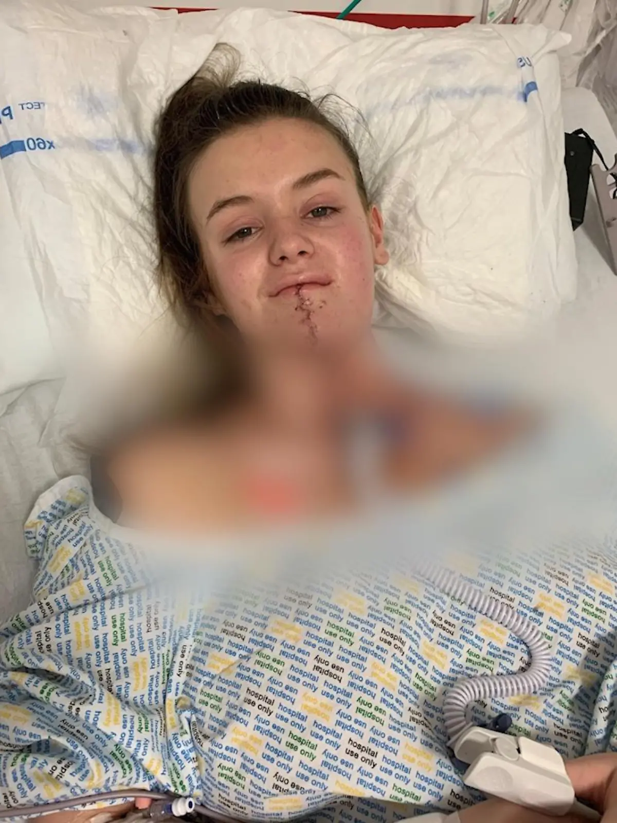 Rachel Morton nach ihrer Zungen-OP